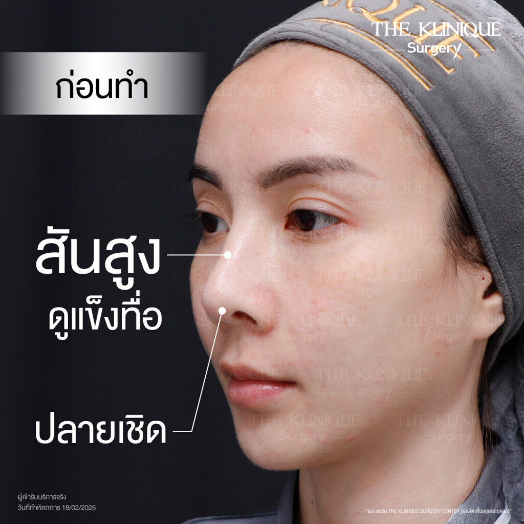 ศัลยกรรมจมูก, ศัลยกรรมจมูก รีวิว, เสริมจมูก, รีวิวเสริมจมูก, ทำจมูก, ทำจมูก รีวิว, ทำจมูก แบบ Open, ซิลิโคนจมูก, จมูก Open, เสริมจมูกโอเพ่น, เสริมจมูกOpen ที่ไหนดี, เสริมจมูกโอเพ่น ที่ไหนดี, เสริมจมูกโอเพ่น Open คือ, รีวิวเสริมจมูกโอเพ่น Open, ทรงจมูก, ทรงจมูกสวย, ทรงจมูกธรรมชาติ, ทรงจมูกสโลปปลายพุ่ง, ศัลยกรรมจมูกทีไ่หนดี, ศัลยกรรมจมูกมีกี่แบบ, เสริมจมูกที่ไหนดี, เสริมจมูกโอเพ่น, เสริมจมูกOpen, ทำจมูกรีวิว, ซิลิโคนจมูก,แก้จมูก, แก้จมูกที่ไหนดี, ทรงจมูกผู้ชาย, เสริมจมูกผู้ชาย, ศัลยฯจมูก, ถอดซิลิโคนจมูก, จมูก Semi Open