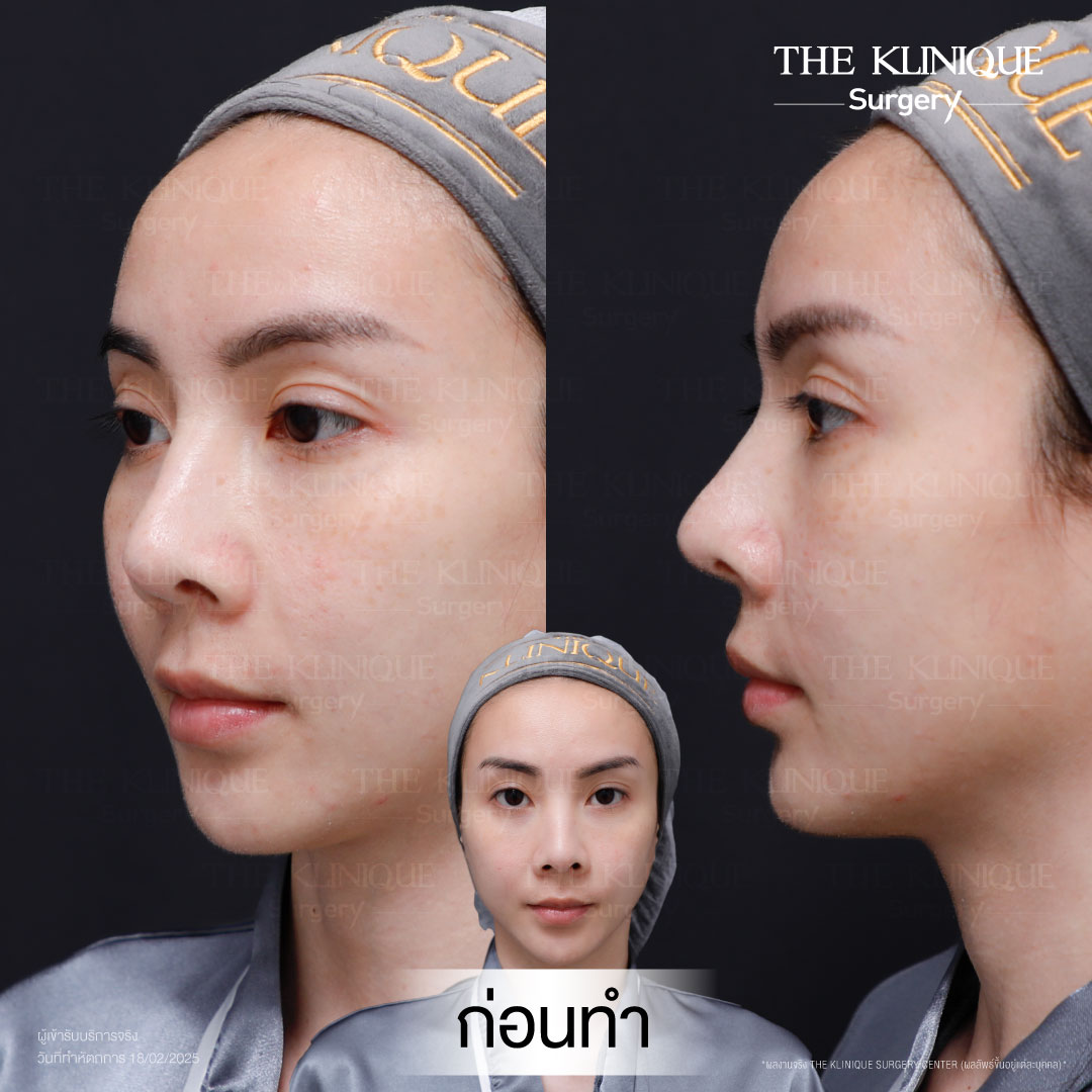 ศัลยกรรมจมูก, ศัลยกรรมจมูก รีวิว, เสริมจมูก, รีวิวเสริมจมูก, ทำจมูก, ทำจมูก รีวิว, ทำจมูก แบบ Open, ซิลิโคนจมูก, จมูก Open, เสริมจมูกโอเพ่น, เสริมจมูกOpen ที่ไหนดี, เสริมจมูกโอเพ่น ที่ไหนดี, เสริมจมูกโอเพ่น Open คือ, รีวิวเสริมจมูกโอเพ่น Open, ทรงจมูก, ทรงจมูกสวย, ทรงจมูกธรรมชาติ, ทรงจมูกสโลปปลายพุ่ง, ศัลยกรรมจมูกทีไ่หนดี, ศัลยกรรมจมูกมีกี่แบบ, เสริมจมูกที่ไหนดี, เสริมจมูกโอเพ่น, เสริมจมูกOpen, ทำจมูกรีวิว, ซิลิโคนจมูก,แก้จมูก, แก้จมูกที่ไหนดี, ทรงจมูกผู้ชาย, เสริมจมูกผู้ชาย, ศัลยฯจมูก, ถอดซิลิโคนจมูก, จมูก Semi Open