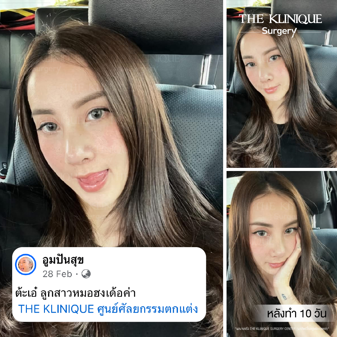 ศัลยกรรมจมูก, ศัลยกรรมจมูก รีวิว, เสริมจมูก, รีวิวเสริมจมูก, ทำจมูก, ทำจมูก รีวิว, ทำจมูก แบบ Open, ซิลิโคนจมูก, จมูก Open, เสริมจมูกโอเพ่น, เสริมจมูกOpen ที่ไหนดี, เสริมจมูกโอเพ่น ที่ไหนดี, เสริมจมูกโอเพ่น Open คือ, รีวิวเสริมจมูกโอเพ่น Open, ทรงจมูก, ทรงจมูกสวย, ทรงจมูกธรรมชาติ, ทรงจมูกสโลปปลายพุ่ง, ศัลยกรรมจมูกทีไ่หนดี, ศัลยกรรมจมูกมีกี่แบบ, เสริมจมูกที่ไหนดี, เสริมจมูกโอเพ่น, เสริมจมูกOpen, ทำจมูกรีวิว, ซิลิโคนจมูก,แก้จมูก, แก้จมูกที่ไหนดี, ทรงจมูกผู้ชาย, เสริมจมูกผู้ชาย, ศัลยฯจมูก, ถอดซิลิโคนจมูก, จมูก Semi Open