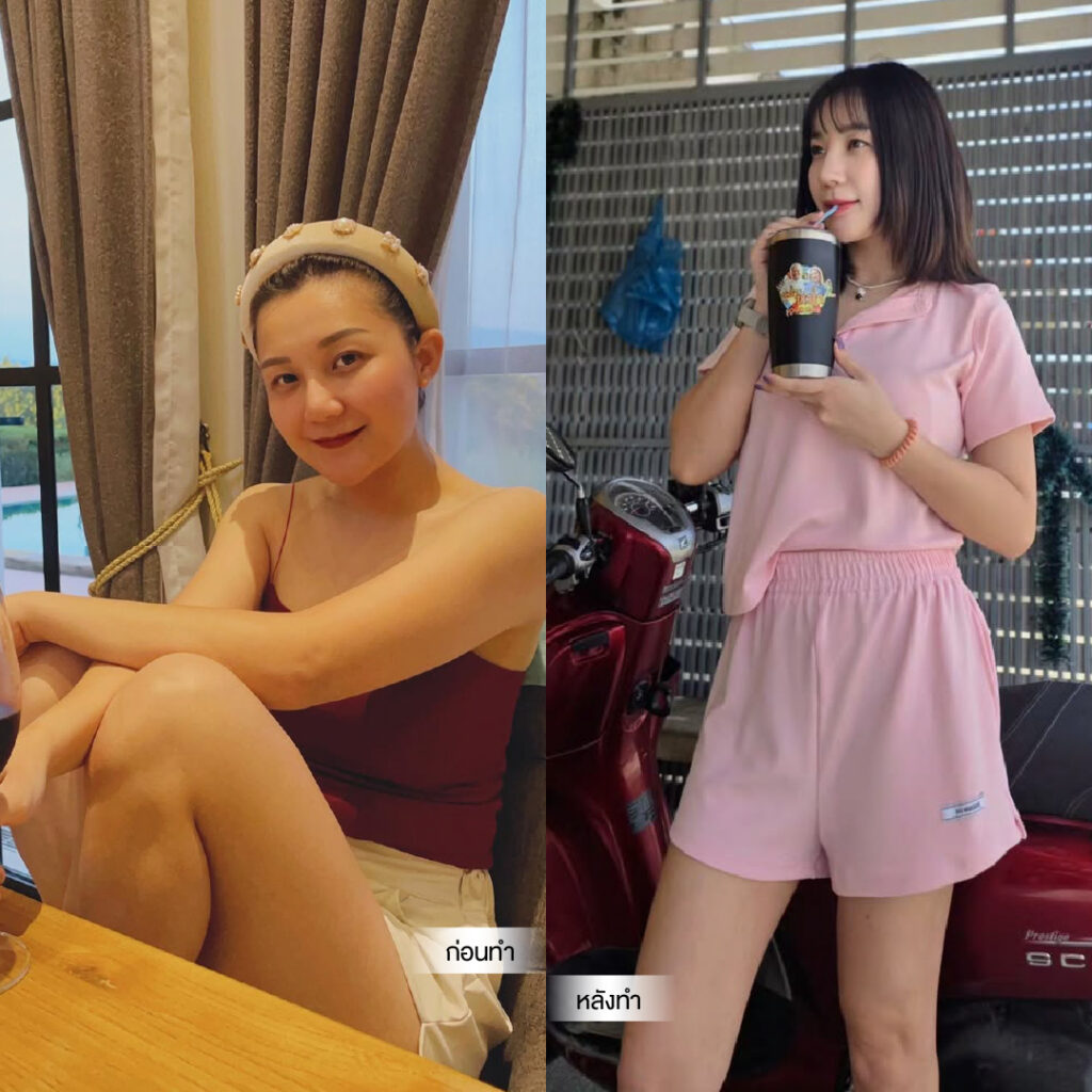 Liposuction, Sculpting,Xshape,Lipo, ศัลยกรรมดูดไขมัน, ดูดไขมัน,คลินิกดูดไขมัน,ดูดไขมันเฉพาะส่วน,ดูดไขมันเหนียง,ดูดไขมันหน้าท้อง,ดูดไขมันรีวิว, รีวิวดูดไขมัน, รีวิวดูดไขมันหน้าท้อง,ดูดไขมันต้นแขน, ดูดไขมันต้นขา,ดูดไขมันน่อง, ลดความอ้วน, ดูดไขมันที่ไหนดี, ดูดไขมันราคา, ดูดไขมันทั้งตัว,รีวิวดูดไขมันต้นขา, ลดไขมันต้นขา, เหลาเขาเรียว