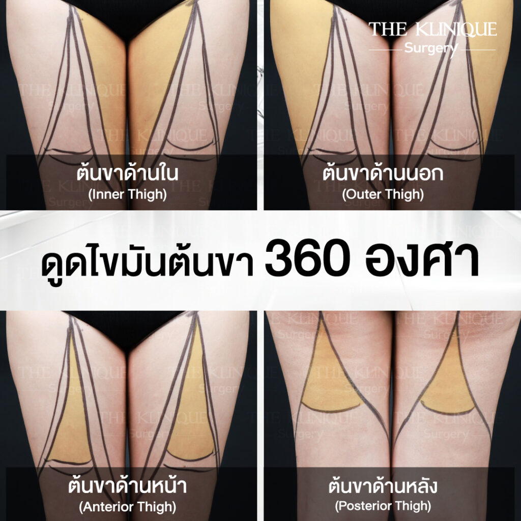 Liposuction, Sculpting,Xshape,Lipo, ศัลยกรรมดูดไขมัน, ดูดไขมัน,คลินิกดูดไขมัน,ดูดไขมันเฉพาะส่วน,ดูดไขมันเหนียง,ดูดไขมันหน้าท้อง,ดูดไขมันรีวิว, รีวิวดูดไขมัน, รีวิวดูดไขมันหน้าท้อง,ดูดไขมันต้นแขน, ดูดไขมันต้นขา,ดูดไขมันน่อง, ลดความอ้วน, ดูดไขมันที่ไหนดี, ดูดไขมันราคา, ดูดไขมันทั้งตัว,รีวิวดูดไขมันต้นขา, ลดไขมันต้นขา, เหลาเขาเรียว