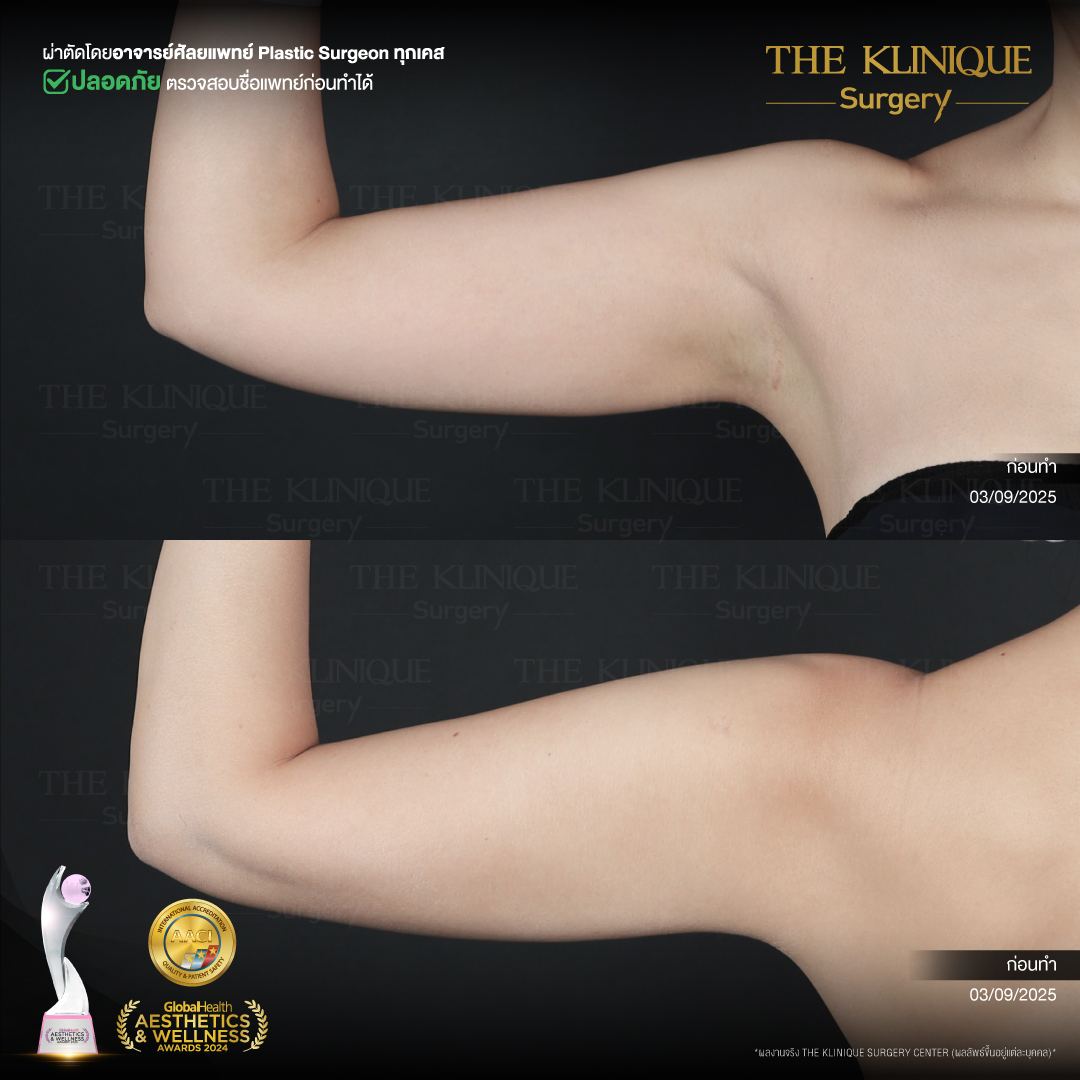 Liposuction, Sculpting,Xshape,Lipo, ศัลยกรรมดูดไขมัน, ดูดไขมัน,คลินิกดูดไขมัน,ดูดไขมันเฉพาะส่วน,ดูดไขมันเหนียง,ดูดไขมันหน้าท้อง,ดูดไขมันรีวิว, รีวิวดูดไขมัน, รีวิวดูดไขมันหน้าท้อง,ดูดไขมันต้นแขน, ดูดไขมันต้นขา,ดูดไขมันน่อง, ลดความอ้วน, ดูดไขมันที่ไหนดี, ดูดไขมันราคา, ดูดไขมันทั้งตัว, รีวิว ดูดไขมันต้นขา, ดูดไขมันขา