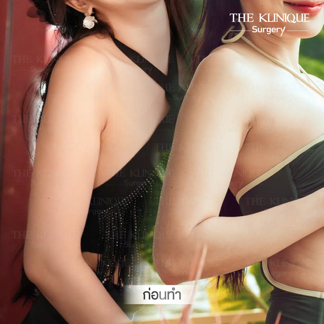 Liposuction, Sculpting,Xshape,Lipo, ศัลยกรรมดูดไขมัน, ดูดไขมัน,คลินิกดูดไขมัน,ดูดไขมันเฉพาะส่วน,ดูดไขมันเหนียง,ดูดไขมันหน้าท้อง,ดูดไขมันรีวิว, รีวิวดูดไขมัน, รีวิวดูดไขมันหน้าท้อง,ดูดไขมันต้นแขน, ดูดไขมันต้นขา,ดูดไขมันน่อง, ลดความอ้วน, ดูดไขมันที่ไหนดี, ดูดไขมันราคา, ดูดไขมันทั้งตัว, รีวิว ดูดไขมันต้นขา, ดูดไขมันขา