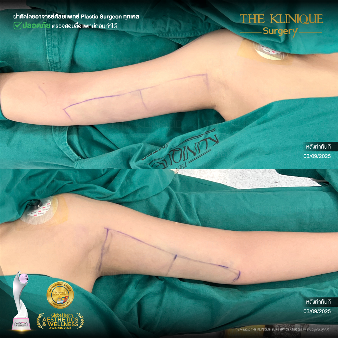 Liposuction, Sculpting,Xshape,Lipo, ศัลยกรรมดูดไขมัน, ดูดไขมัน,คลินิกดูดไขมัน,ดูดไขมันเฉพาะส่วน,ดูดไขมันเหนียง,ดูดไขมันหน้าท้อง,ดูดไขมันรีวิว, รีวิวดูดไขมัน, รีวิวดูดไขมันหน้าท้อง,ดูดไขมันต้นแขน, ดูดไขมันต้นขา,ดูดไขมันน่อง, ลดความอ้วน, ดูดไขมันที่ไหนดี, ดูดไขมันราคา, ดูดไขมันทั้งตัว, รีวิว ดูดไขมันต้นขา, ดูดไขมันขา