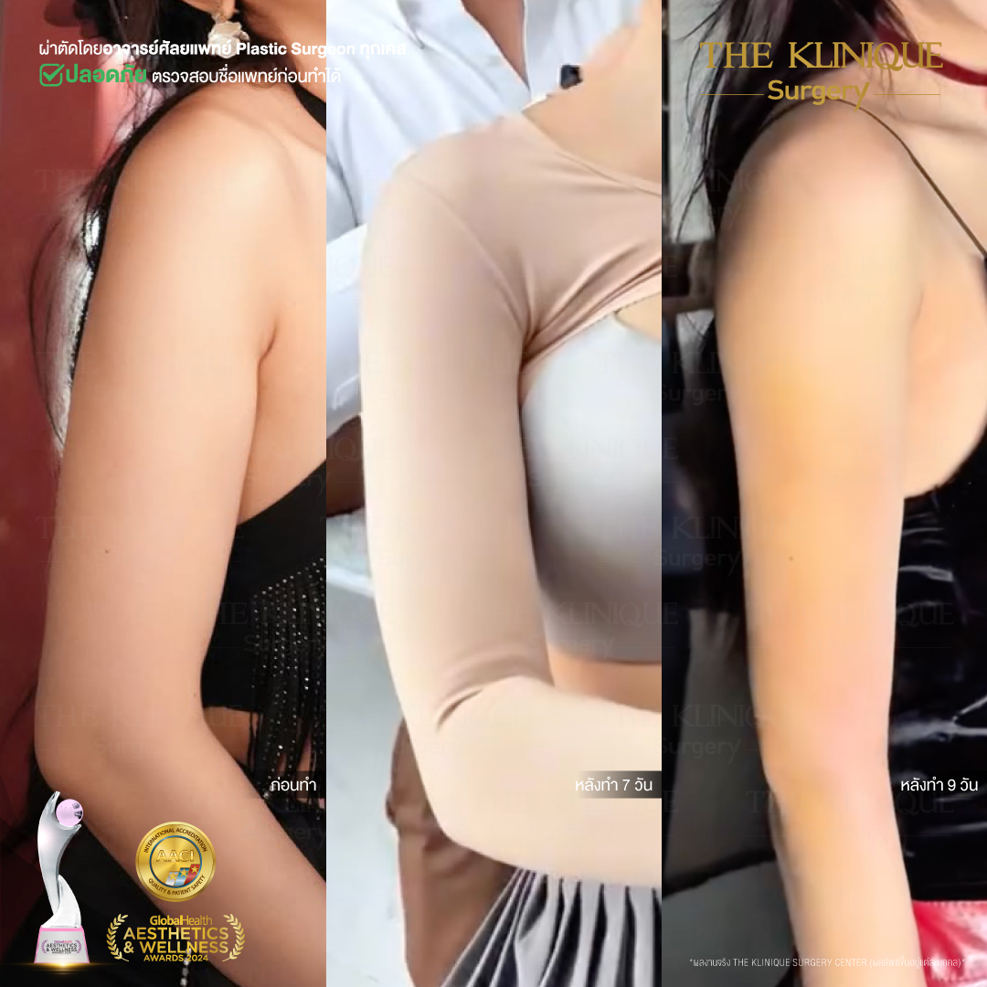 Liposuction, Sculpting,Xshape,Lipo, ศัลยกรรมดูดไขมัน, ดูดไขมัน,คลินิกดูดไขมัน,ดูดไขมันเฉพาะส่วน,ดูดไขมันเหนียง,ดูดไขมันหน้าท้อง,ดูดไขมันรีวิว, รีวิวดูดไขมัน, รีวิวดูดไขมันหน้าท้อง,ดูดไขมันต้นแขน, ดูดไขมันต้นขา,ดูดไขมันน่อง, ลดความอ้วน, ดูดไขมันที่ไหนดี, ดูดไขมันราคา, ดูดไขมันทั้งตัว, รีวิว ดูดไขมันต้นขา, ดูดไขมันขา