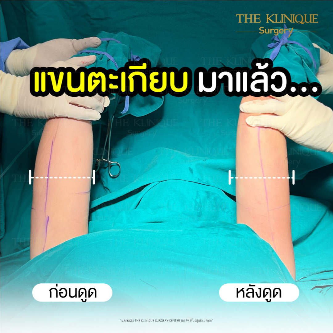 Liposuction, Sculpting,Xshape,Lipo, ศัลยกรรมดูดไขมัน, ดูดไขมัน,คลินิกดูดไขมัน,ดูดไขมันเฉพาะส่วน,ดูดไขมันเหนียง,ดูดไขมันหน้าท้อง,ดูดไขมันรีวิว, รีวิวดูดไขมัน, รีวิวดูดไขมันหน้าท้อง,ดูดไขมันต้นแขน, ดูดไขมันต้นขา,ดูดไขมันน่อง, ลดความอ้วน, ดูดไขมันที่ไหนดี, ดูดไขมันราคา, ดูดไขมันทั้งตัว, รีวิว ดูดไขมันต้นขา, ดูดไขมันขา