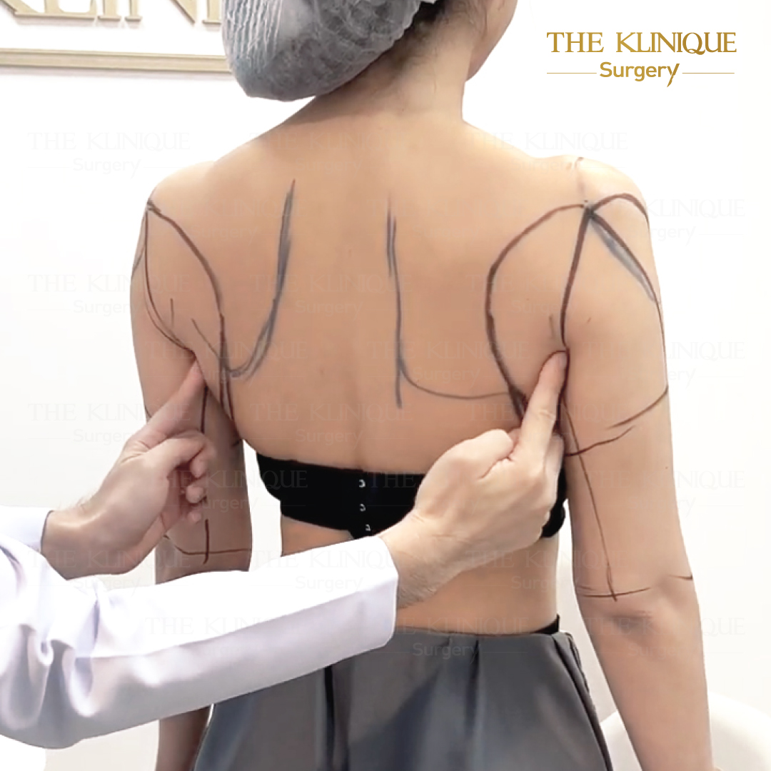 Liposuction, Sculpting,Xshape,Lipo, ศัลยกรรมดูดไขมัน, ดูดไขมัน,คลินิกดูดไขมัน,ดูดไขมันเฉพาะส่วน,ดูดไขมันเหนียง,ดูดไขมันหน้าท้อง,ดูดไขมันรีวิว, รีวิวดูดไขมัน, รีวิวดูดไขมันหน้าท้อง,ดูดไขมันต้นแขน, ดูดไขมันต้นขา,ดูดไขมันน่อง, ลดความอ้วน, ดูดไขมันที่ไหนดี, ดูดไขมันราคา, ดูดไขมันทั้งตัว, รีวิว ดูดไขมันต้นขา, ดูดไขมันขา