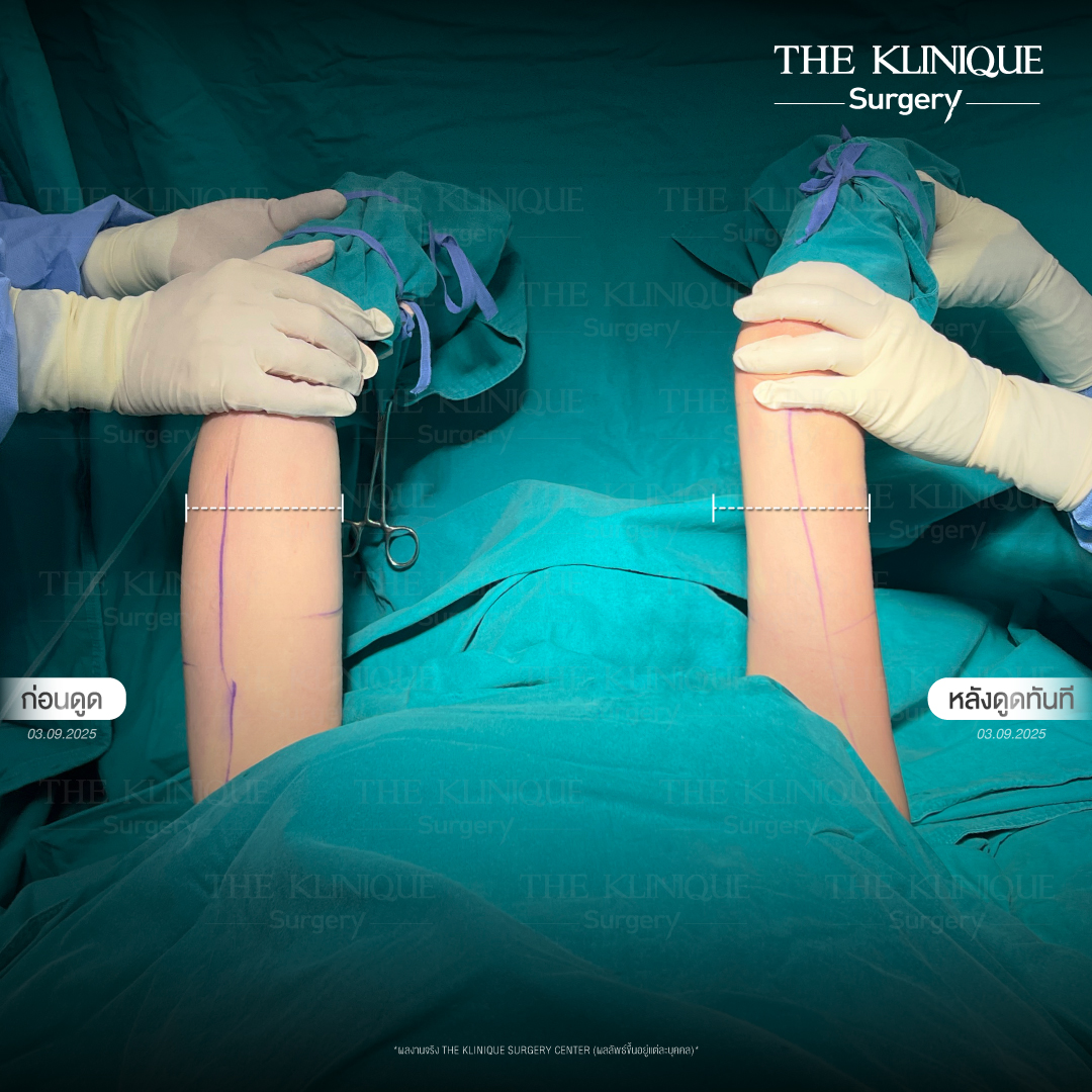 Liposuction, Sculpting,Xshape,Lipo, ศัลยกรรมดูดไขมัน, ดูดไขมัน,คลินิกดูดไขมัน,ดูดไขมันเฉพาะส่วน,ดูดไขมันเหนียง,ดูดไขมันหน้าท้อง,ดูดไขมันรีวิว, รีวิวดูดไขมัน, รีวิวดูดไขมันหน้าท้อง,ดูดไขมันต้นแขน, ดูดไขมันต้นขา,ดูดไขมันน่อง, ลดความอ้วน, ดูดไขมันที่ไหนดี, ดูดไขมันราคา, ดูดไขมันทั้งตัว, รีวิว ดูดไขมันต้นขา, ดูดไขมันขา