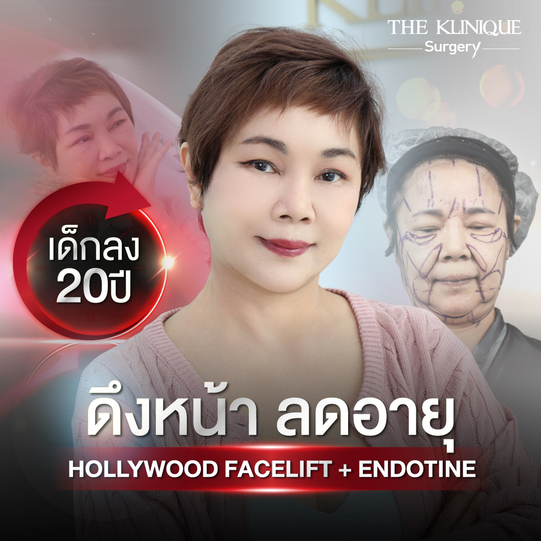 ศัลยกรรมดึงหน้า, ดึงหน้า, ดึงหน้าผาก, ดึงหน้าผาก ยกคิ้ว, Face Lock, Face Lift, ดึงหน้า ดึงคอ, ดึงหน้าย้อนวัย, ดึงหน้าดารา, Necklift, Face Lift คือ,Endotine หน้าผาก,ดึงหน้าผาก ยกคิ้ว, ศัลยกรรมดึงหน้าผาก, ดึงหน้าย้อนวัย, ศัลยกรรมยกคิ้ว, รีวิวศัลยกรรมยกคิ้ว, Endotine, Endotine รีวิว, ยกคิ้วส่องกล้อง, ผ่าตัดส่องกล้อง, ผ่าตัดดึงหน้า, Endotine รีวิว, ยกคิ้ว รีวิว, ยกคิ้วส่องกล้อง, ยกคิ้วส่องกล้อง รีวิว, ยกคิ้วที่ไหนดี