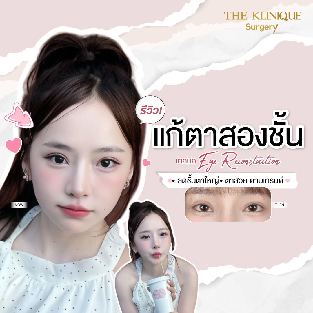 ศัลยกรรมตา, ศัลยกรรมตาสองชั้น, ศัลยกรรมตาสองชั้น ราคา, ศัลยกรรมตาที่ไหนดี, ศัลยกรรมตามีกี่แบบ, ตาสองชั้น, ตาสองชั้นหลบใน, คลินิกทำตา, ตาสองชั้นที่ไหนดี, ตาสองชั้นแบบกรีดสั้น กรีดยาว, กล้ามเนื้อตาอ่อนแรง, แก้ตา, แก้ตาสองชั้น, แก้หนังตาตก, แก้ชั้นตาใหญ่, แก้ตาไม่เท่ากัน, หนังตาตก, แก้หนังตาตก, ตาสองชั้นรีวิว, ตา 2 ชั้น, รีวิว ตาสองชั้น, ทำตาสองชั้น, Sub Brow Lift, Foxy eyes, ยกหางตา, หางตาตก, หมอศัลยกรรมตา 
