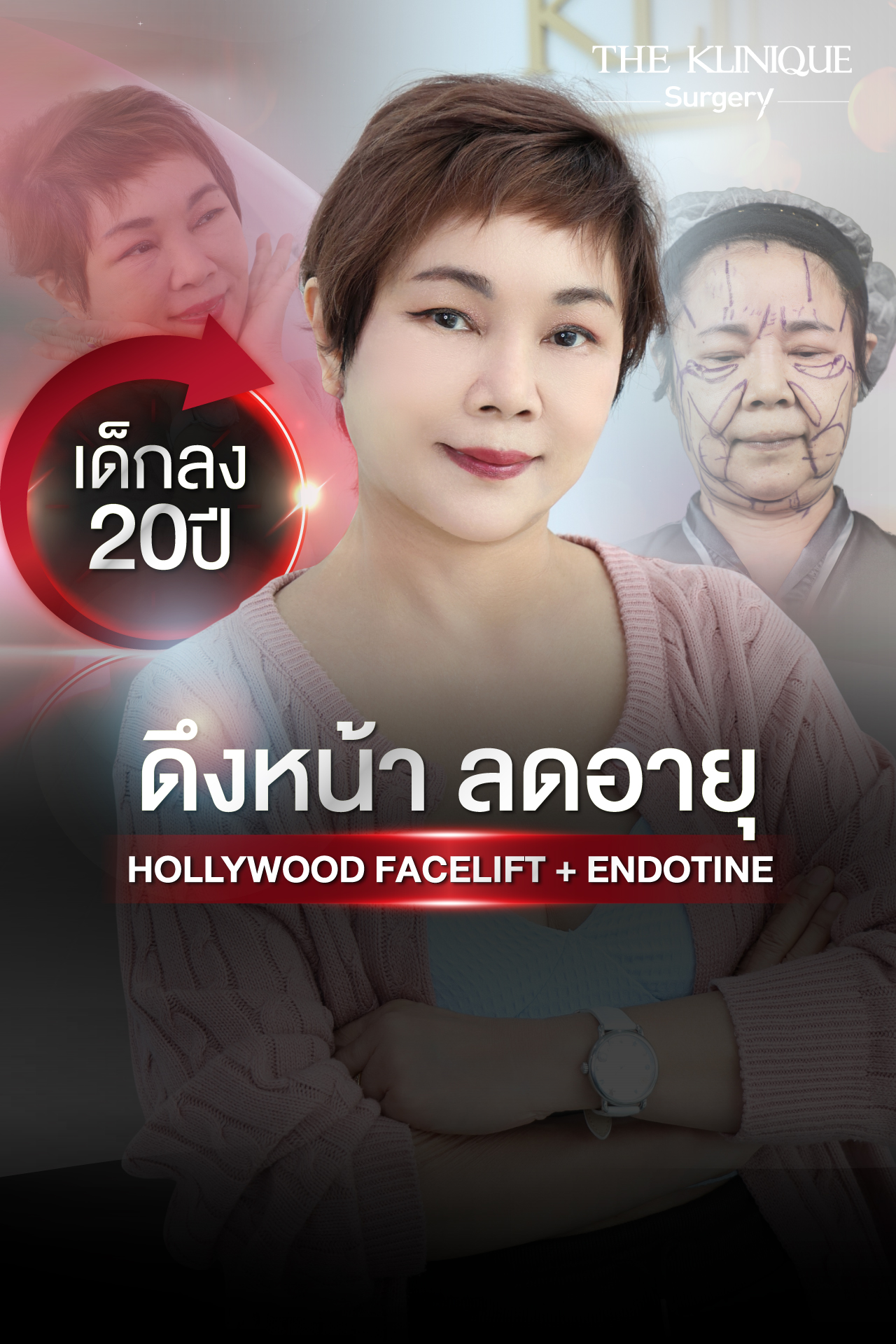 ศัลยกรรมดึงหน้า, ดึงหน้า, ดึงหน้าผาก, ดึงหน้าผาก ยกคิ้ว, Face Lock, Face Lift, ดึงหน้า ดึงคอ, ดึงหน้าย้อนวัย, ดึงหน้าดารา, Necklift, Face Lift คือ,Endotine หน้าผาก,ดึงหน้าผาก ยกคิ้ว, ศัลยกรรมดึงหน้าผาก, ดึงหน้าย้อนวัย, ศัลยกรรมยกคิ้ว, รีวิวศัลยกรรมยกคิ้ว, Endotine, Endotine รีวิว, ยกคิ้วส่องกล้อง, ผ่าตัดส่องกล้อง, ผ่าตัดดึงหน้า, Endotine รีวิว, ยกคิ้ว รีวิว, ยกคิ้วส่องกล้อง, ยกคิ้วส่องกล้อง รีวิว, ยกคิ้วที่ไหนดี