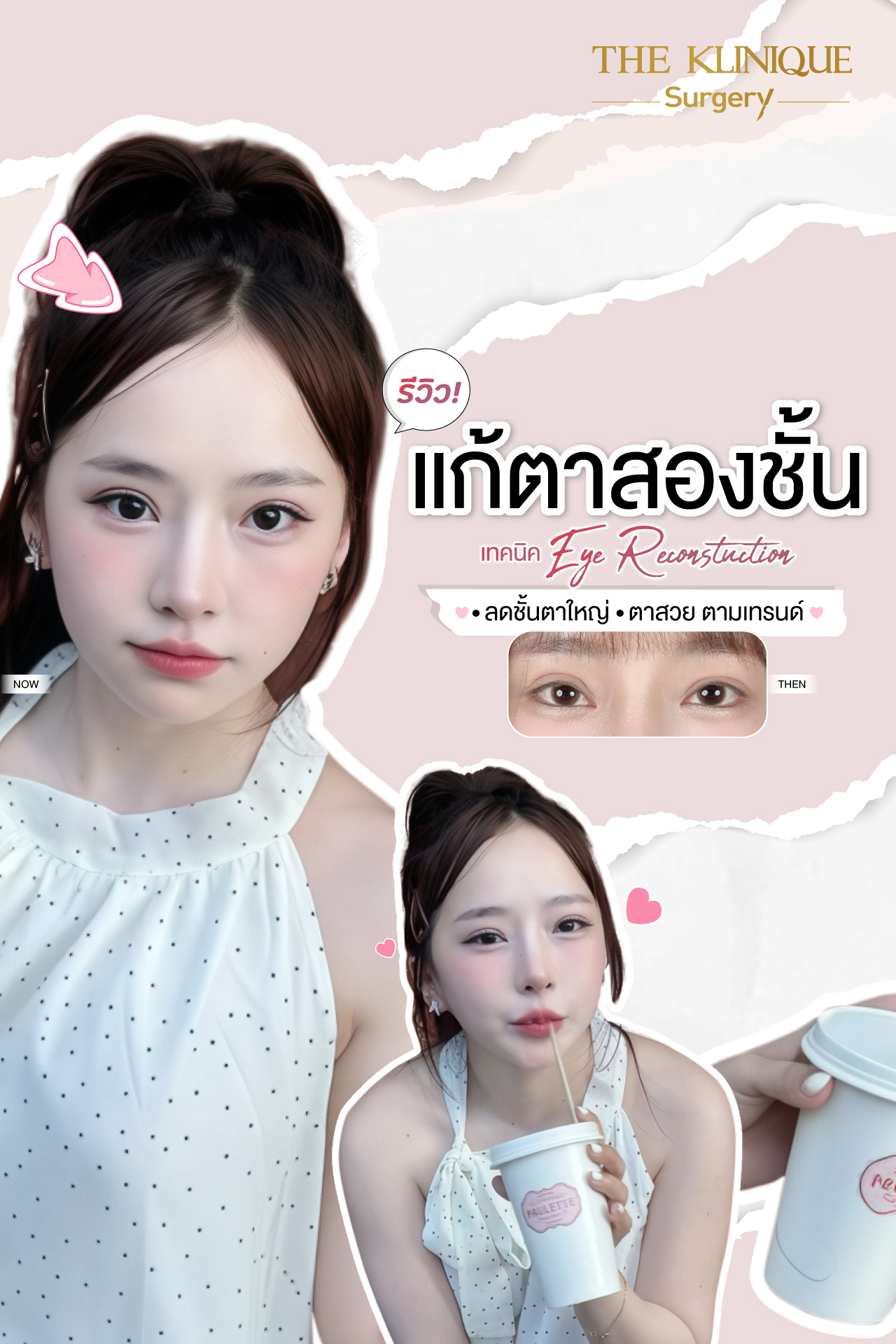 ศัลยกรรมตา, ศัลยกรรมตาสองชั้น, ศัลยกรรมตาสองชั้น ราคา, ศัลยกรรมตาที่ไหนดี, ศัลยกรรมตามีกี่แบบ, ตาสองชั้น, ตาสองชั้นหลบใน, คลินิกทำตา, ตาสองชั้นที่ไหนดี, ตาสองชั้นแบบกรีดสั้น กรีดยาว, กล้ามเนื้อตาอ่อนแรง, แก้ตา, แก้ตาสองชั้น, แก้หนังตาตก, แก้ชั้นตาใหญ่, แก้ตาไม่เท่ากัน, หนังตาตก, แก้หนังตาตก, ตาสองชั้นรีวิว, ตา 2 ชั้น, รีวิว ตาสองชั้น, ทำตาสองชั้น, Sub Brow Lift, Foxy eyes, ยกหางตา, หางตาตก, หมอศัลยกรรมตา