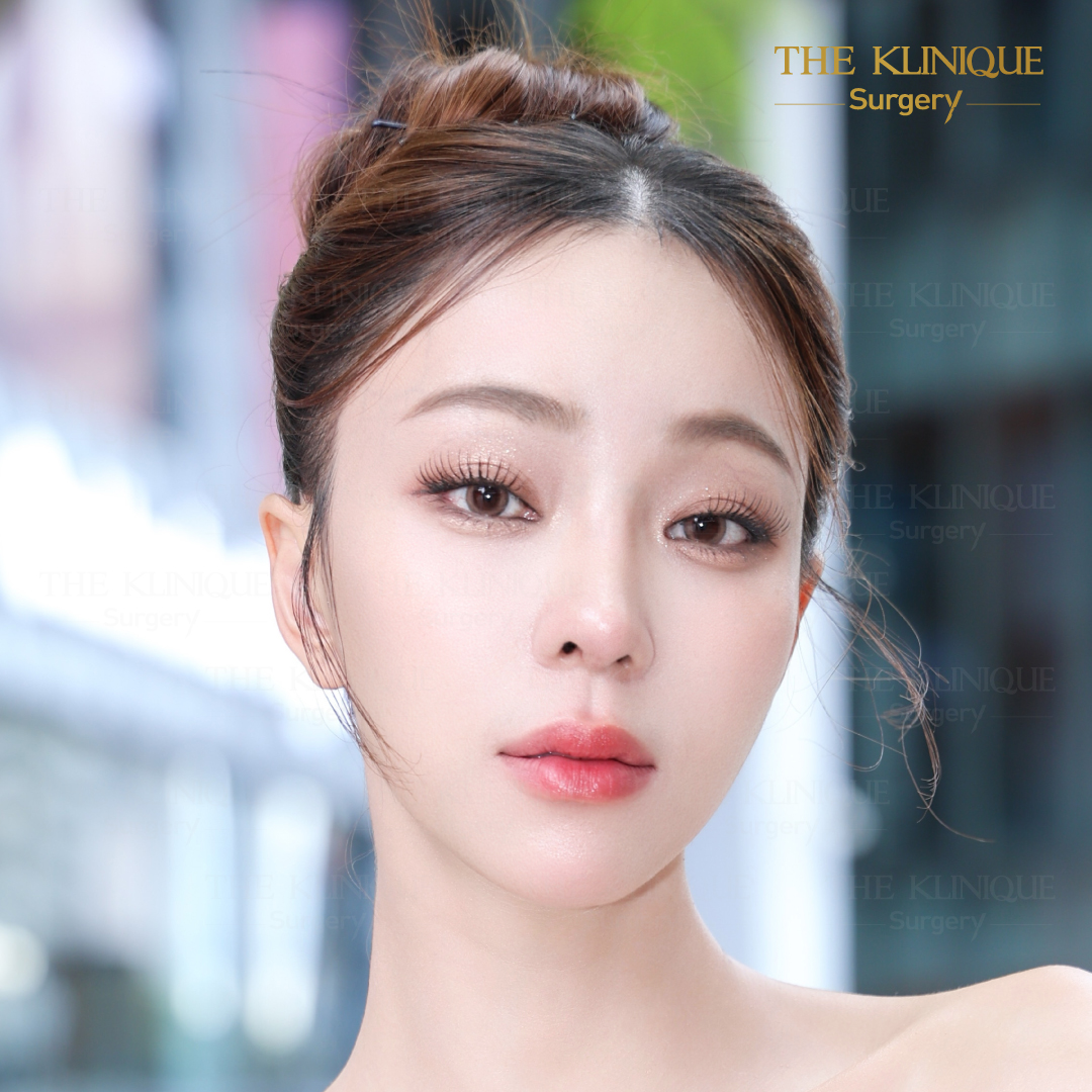 ดึงหน้า, ศัลยกรรมดึงหน้า,ดึงหน้าย้อนวัย, ดึงหน้าที่ไหนดี, ผ่าตัดดึงหน้า, ยกคิ้ว, ยกหางตา, หางตาตก, ดึงหน้าดารา, ดึงหน้ารีวิว, Facelift, Neck lift, Endotine, ยกคิ้ว Endotine,Foxy Eyes, แก้หนังตาตก , แก้ตาไม่เท่ากัน ,หนังตาตก,แก้หนังตาตก,ยกคิ้ว รีวิว, ยกคิ้วส่องกล้อง, ยกคิ้วที่ไหนดี, ยกคิ้ว,ศัลยกรรมยกคิ้ว, Facelift รีวิว, ดึงหน้า Facelift