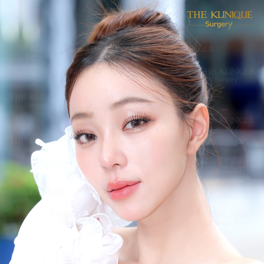 ดึงหน้า, ศัลยกรรมดึงหน้า,ดึงหน้าย้อนวัย, ดึงหน้าที่ไหนดี, ผ่าตัดดึงหน้า, ยกคิ้ว, ยกหางตา, หางตาตก, ดึงหน้าดารา, ดึงหน้ารีวิว, Facelift, Neck lift, Endotine, ยกคิ้ว Endotine,Foxy Eyes, แก้หนังตาตก , แก้ตาไม่เท่ากัน ,หนังตาตก,แก้หนังตาตก,ยกคิ้ว รีวิว, ยกคิ้วส่องกล้อง, ยกคิ้วที่ไหนดี, ยกคิ้ว,ศัลยกรรมยกคิ้ว, Facelift รีวิว, ดึงหน้า Facelift