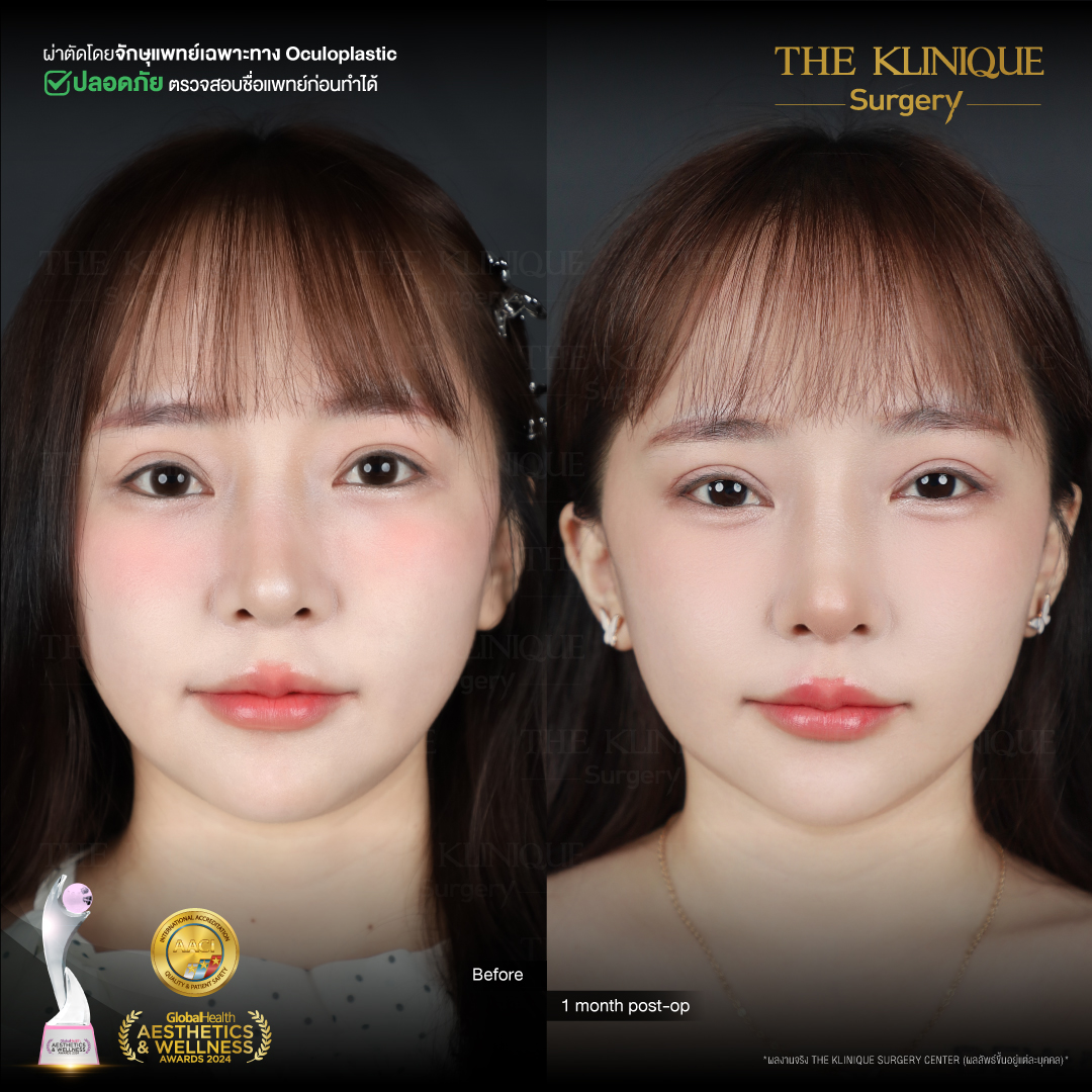 ศัลยกรรมตา, ศัลยกรรมตาสองชั้น, ศัลยกรรมตาสองชั้น ราคา, ศัลยกรรมตาที่ไหนดี, ศัลยกรรมตามีกี่แบบ, ตาสองชั้น, ตาสองชั้นหลบใน, คลินิกทำตา, ตาสองชั้นที่ไหนดี, ตาสองชั้นแบบกรีดสั้น กรีดยาว, กล้ามเนื้อตาอ่อนแรง, แก้ตา, แก้ตาสองชั้น, แก้หนังตาตก, แก้ชั้นตาใหญ่, แก้ตาไม่เท่ากัน, หนังตาตก, แก้หนังตาตก, ตาสองชั้นรีวิว, ตา 2 ชั้น, รีวิว ตาสองชั้น, ทำตาสองชั้น, Sub Brow Lift, Foxy eyes, ยกหางตา, หางตาตก, หมอศัลยกรรมตา