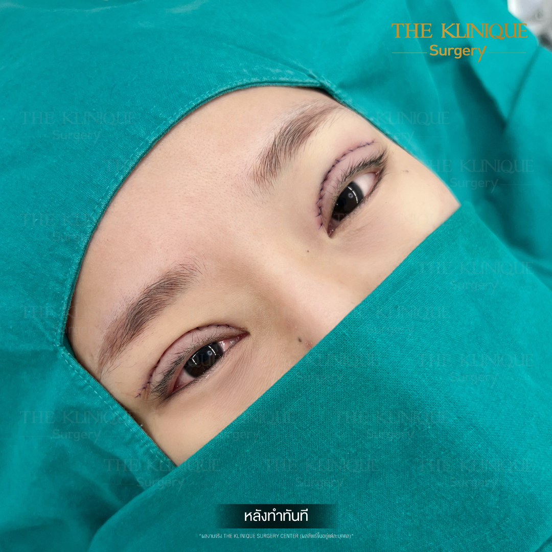 ศัลยกรรมตา, ศัลยกรรมตาสองชั้น, ศัลยกรรมตาสองชั้น ราคา, ศัลยกรรมตาที่ไหนดี, ศัลยกรรมตามีกี่แบบ, ตาสองชั้น, ตาสองชั้นหลบใน, คลินิกทำตา, ตาสองชั้นที่ไหนดี, ตาสองชั้นแบบกรีดสั้น กรีดยาว, กล้ามเนื้อตาอ่อนแรง, แก้ตา, แก้ตาสองชั้น, แก้หนังตาตก, แก้ชั้นตาใหญ่, แก้ตาไม่เท่ากัน, หนังตาตก, แก้หนังตาตก, ตาสองชั้นรีวิว, ตา 2 ชั้น, รีวิว ตาสองชั้น, ทำตาสองชั้น, Sub Brow Lift, Foxy eyes, ยกหางตา, หางตาตก, หมอศัลยกรรมตา