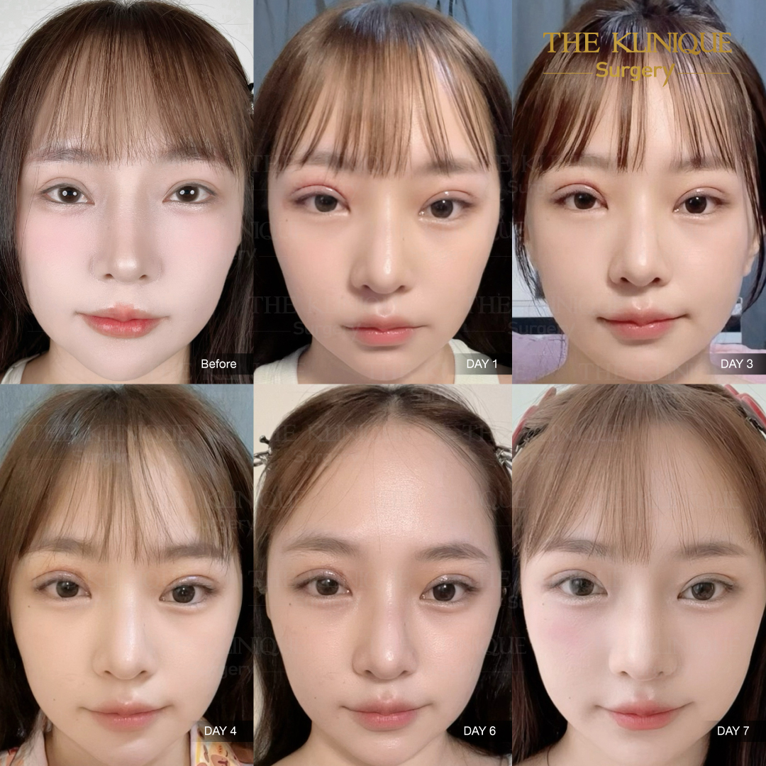 ศัลยกรรมตา, ศัลยกรรมตาสองชั้น, ศัลยกรรมตาสองชั้น ราคา, ศัลยกรรมตาที่ไหนดี, ศัลยกรรมตามีกี่แบบ, ตาสองชั้น, ตาสองชั้นหลบใน, คลินิกทำตา, ตาสองชั้นที่ไหนดี, ตาสองชั้นแบบกรีดสั้น กรีดยาว, กล้ามเนื้อตาอ่อนแรง, แก้ตา, แก้ตาสองชั้น, แก้หนังตาตก, แก้ชั้นตาใหญ่, แก้ตาไม่เท่ากัน, หนังตาตก, แก้หนังตาตก, ตาสองชั้นรีวิว, ตา 2 ชั้น, รีวิว ตาสองชั้น, ทำตาสองชั้น, Sub Brow Lift, Foxy eyes, ยกหางตา, หางตาตก, หมอศัลยกรรมตา