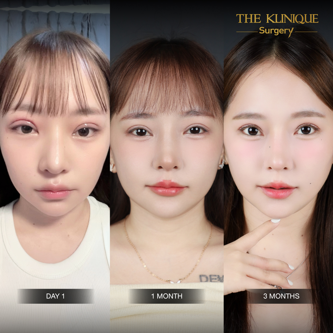 ศัลยกรรมตา, ศัลยกรรมตาสองชั้น, ศัลยกรรมตาสองชั้น ราคา, ศัลยกรรมตาที่ไหนดี, ศัลยกรรมตามีกี่แบบ, ตาสองชั้น, ตาสองชั้นหลบใน, คลินิกทำตา, ตาสองชั้นที่ไหนดี, ตาสองชั้นแบบกรีดสั้น กรีดยาว, กล้ามเนื้อตาอ่อนแรง, แก้ตา, แก้ตาสองชั้น, แก้หนังตาตก, แก้ชั้นตาใหญ่, แก้ตาไม่เท่ากัน, หนังตาตก, แก้หนังตาตก, ตาสองชั้นรีวิว, ตา 2 ชั้น, รีวิว ตาสองชั้น, ทำตาสองชั้น, Sub Brow Lift, Foxy eyes, ยกหางตา, หางตาตก, หมอศัลยกรรมตา