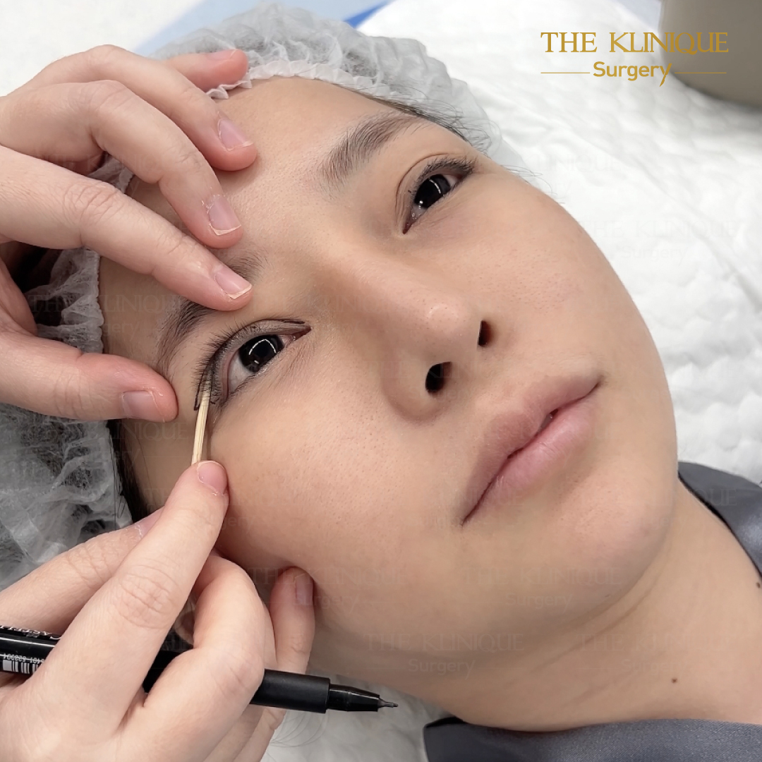 ศัลยกรรมตา, ศัลยกรรมตาสองชั้น, ศัลยกรรมตาสองชั้น ราคา, ศัลยกรรมตาที่ไหนดี, ศัลยกรรมตามีกี่แบบ, ตาสองชั้น, ตาสองชั้นหลบใน, คลินิกทำตา, ตาสองชั้นที่ไหนดี, ตาสองชั้นแบบกรีดสั้น กรีดยาว, กล้ามเนื้อตาอ่อนแรง, แก้ตา, แก้ตาสองชั้น, แก้หนังตาตก, แก้ชั้นตาใหญ่, แก้ตาไม่เท่ากัน, หนังตาตก, แก้หนังตาตก, ตาสองชั้นรีวิว, ตา 2 ชั้น, รีวิว ตาสองชั้น, ทำตาสองชั้น, Sub Brow Lift, Foxy eyes, ยกหางตา, หางตาตก, หมอศัลยกรรมตา