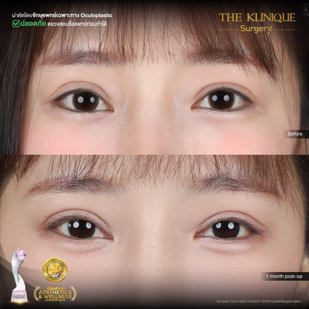 ศัลยกรรมตา, ศัลยกรรมตาสองชั้น, ศัลยกรรมตาสองชั้น ราคา, ศัลยกรรมตาที่ไหนดี, ศัลยกรรมตามีกี่แบบ, ตาสองชั้น, ตาสองชั้นหลบใน, คลินิกทำตา, ตาสองชั้นที่ไหนดี, ตาสองชั้นแบบกรีดสั้น กรีดยาว, กล้ามเนื้อตาอ่อนแรง, แก้ตา, แก้ตาสองชั้น, แก้หนังตาตก, แก้ชั้นตาใหญ่, แก้ตาไม่เท่ากัน, หนังตาตก, แก้หนังตาตก, ตาสองชั้นรีวิว, ตา 2 ชั้น, รีวิว ตาสองชั้น, ทำตาสองชั้น, Sub Brow Lift, Foxy eyes, ยกหางตา, หางตาตก, หมอศัลยกรรมตา