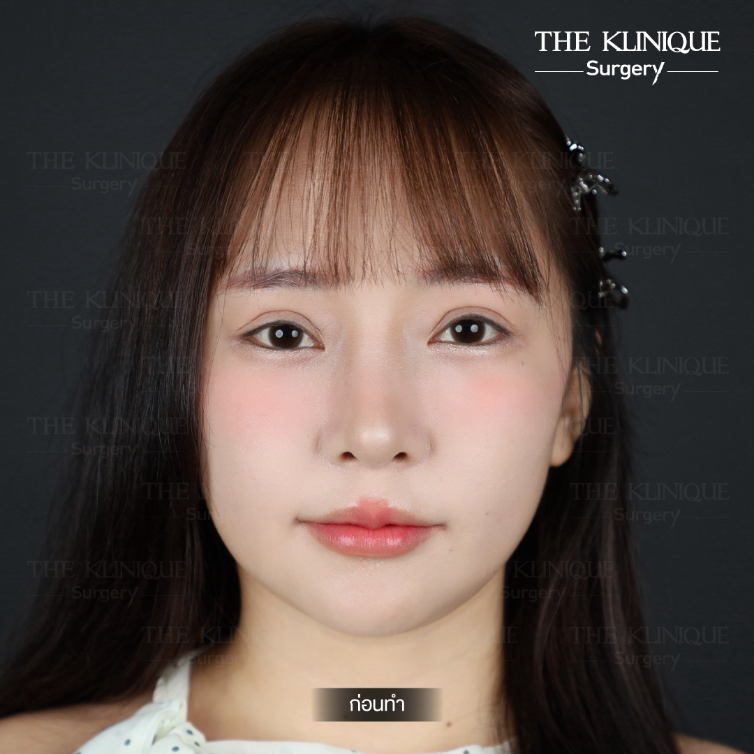 ศัลยกรรมตา, ศัลยกรรมตาสองชั้น, ศัลยกรรมตาสองชั้น ราคา, ศัลยกรรมตาที่ไหนดี, ศัลยกรรมตามีกี่แบบ, ตาสองชั้น, ตาสองชั้นหลบใน, คลินิกทำตา, ตาสองชั้นที่ไหนดี, ตาสองชั้นแบบกรีดสั้น กรีดยาว, กล้ามเนื้อตาอ่อนแรง, แก้ตา, แก้ตาสองชั้น, แก้หนังตาตก, แก้ชั้นตาใหญ่, แก้ตาไม่เท่ากัน, หนังตาตก, แก้หนังตาตก, ตาสองชั้นรีวิว, ตา 2 ชั้น, รีวิว ตาสองชั้น, ทำตาสองชั้น, Sub Brow Lift, Foxy eyes, ยกหางตา, หางตาตก, หมอศัลยกรรมตา 