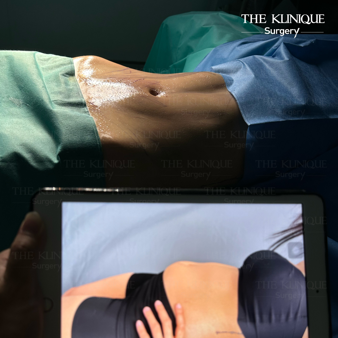 Liposuction, Sculpting,Xshape,Lipo, ศัลยกรรมดูดไขมัน, ดูดไขมัน,คลินิกดูดไขมัน,ดูดไขมันเฉพาะส่วน,ดูดไขมันเหนียง,ดูดไขมันหน้าท้อง,ดูดไขมันรีวิว, รีวิวดูดไขมัน, รีวิวดูดไขมันหน้าท้อง,ดูดไขมันต้นแขน, ดูดไขมันต้นขา,ดูดไขมันน่อง, ลดความอ้วน, ดูดไขมันที่ไหนดี, ดูดไขมันราคา, ดูดไขมันทั้งตัว