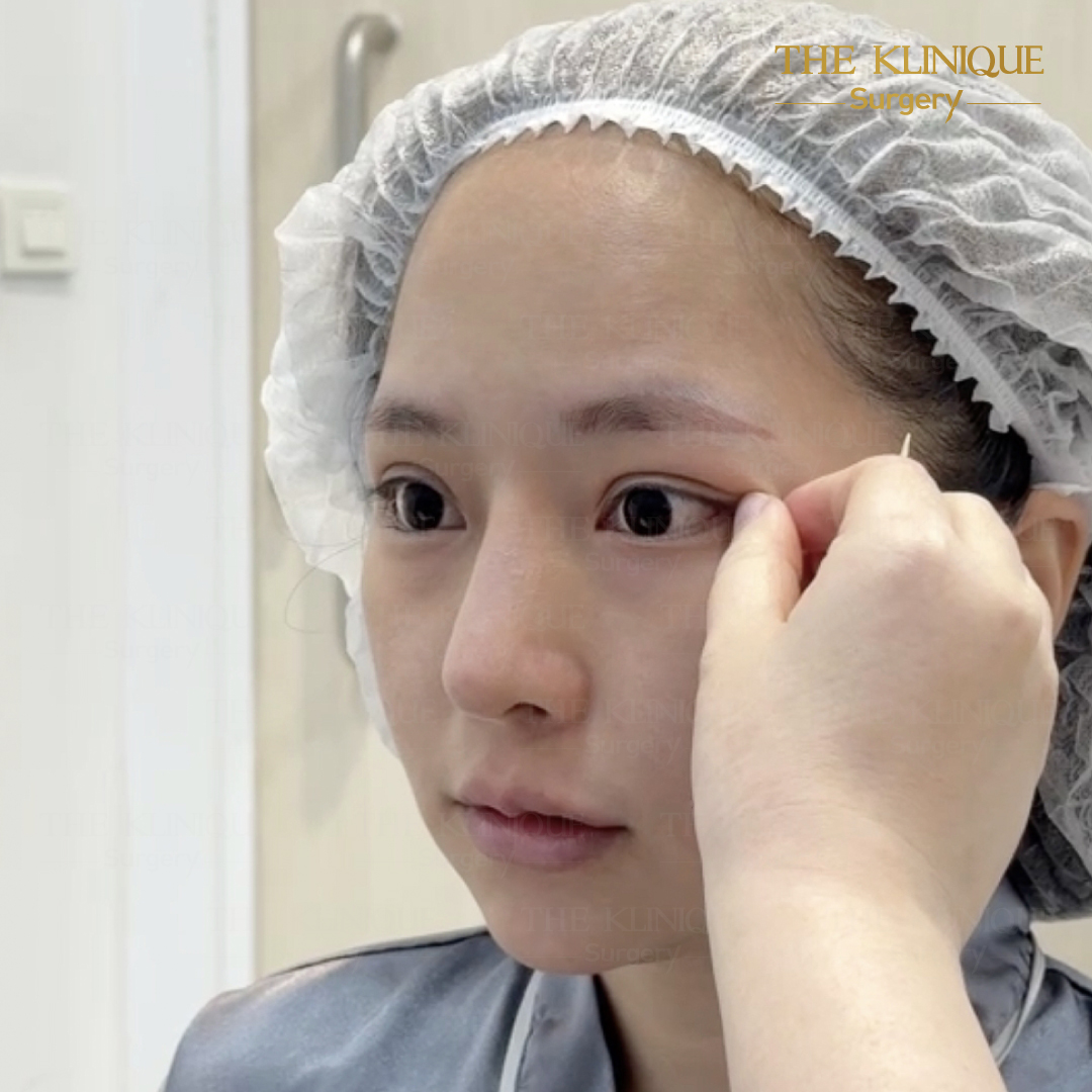 ศัลยกรรมตา, ศัลยกรรมตาสองชั้น, ศัลยกรรมตาสองชั้น ราคา, ศัลยกรรมตาที่ไหนดี, ศัลยกรรมตามีกี่แบบ, ตาสองชั้น, ตาสองชั้นหลบใน, คลินิกทำตา, ตาสองชั้นที่ไหนดี, ตาสองชั้นแบบกรีดสั้น กรีดยาว, กล้ามเนื้อตาอ่อนแรง, แก้ตา, แก้ตาสองชั้น, แก้หนังตาตก, แก้ชั้นตาใหญ่, แก้ตาไม่เท่ากัน, หนังตาตก, แก้หนังตาตก, ตาสองชั้นรีวิว, ตา 2 ชั้น, รีวิว ตาสองชั้น, ทำตาสองชั้น, Sub Brow Lift, Foxy eyes, ยกหางตา, หางตาตก, หมอศัลยกรรมตา