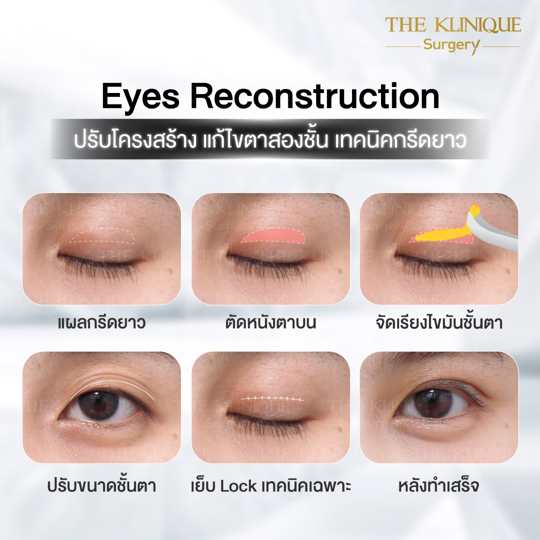 ศัลยกรรมตา, ศัลยกรรมตาสองชั้น, ศัลยกรรมตาสองชั้น ราคา, ศัลยกรรมตาที่ไหนดี, ศัลยกรรมตามีกี่แบบ, ตาสองชั้น, ตาสองชั้นหลบใน, คลินิกทำตา, ตาสองชั้นที่ไหนดี, ตาสองชั้นแบบกรีดสั้น กรีดยาว, กล้ามเนื้อตาอ่อนแรง, แก้ตา, แก้ตาสองชั้น, แก้หนังตาตก, แก้ชั้นตาใหญ่, แก้ตาไม่เท่ากัน, หนังตาตก, แก้หนังตาตก, ตาสองชั้นรีวิว, ตา 2 ชั้น, รีวิว ตาสองชั้น, ทำตาสองชั้น, Sub Brow Lift, Foxy eyes, ยกหางตา, หางตาตก, หมอศัลยกรรมตา 