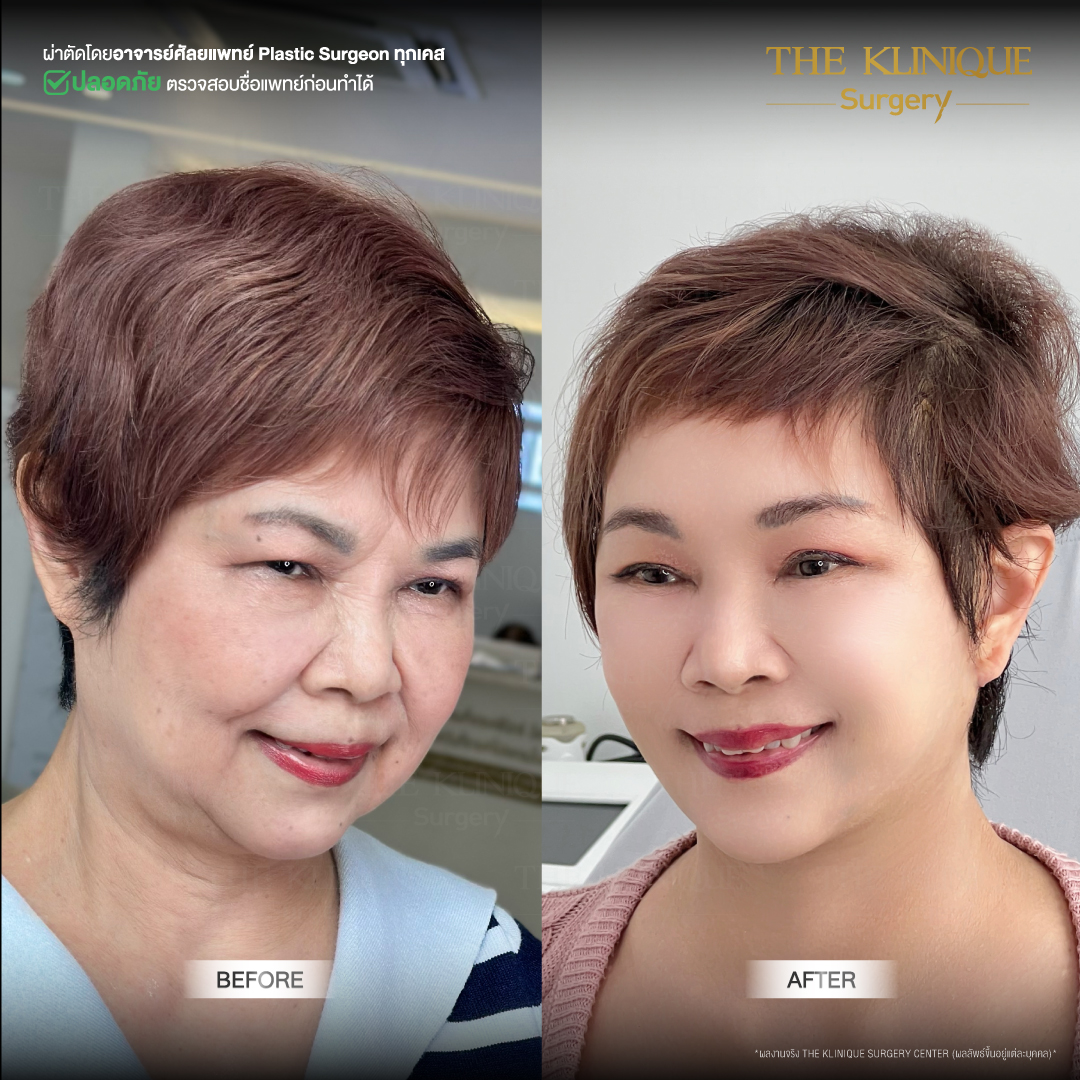 ศัลยกรรมดึงหน้า, ดึงหน้า, ดึงหน้าผาก, ดึงหน้าผาก ยกคิ้ว, Face Lock, Face Lift, ดึงหน้า ดึงคอ, ดึงหน้าย้อนวัย, ดึงหน้าดารา, Necklift, Face Lift คือ,Endotine หน้าผาก,ดึงหน้าผาก ยกคิ้ว, ศัลยกรรมดึงหน้าผาก, ดึงหน้าย้อนวัย, ศัลยกรรมยกคิ้ว, รีวิวศัลยกรรมยกคิ้ว, Endotine, Endotine รีวิว, ยกคิ้วส่องกล้อง, ผ่าตัดส่องกล้อง, ผ่าตัดดึงหน้า, Endotine รีวิว, ยกคิ้ว รีวิว, ยกคิ้วส่องกล้อง, ยกคิ้วส่องกล้อง รีวิว, ยกคิ้วที่ไหนดี