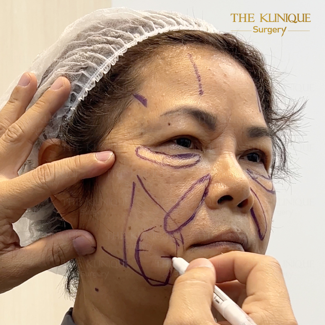 ศัลยกรรมดึงหน้า, ดึงหน้า, ดึงหน้าผาก, ดึงหน้าผาก ยกคิ้ว, Face Lock, Face Lift, ดึงหน้า ดึงคอ, ดึงหน้าย้อนวัย, ดึงหน้าดารา, Necklift, Face Lift คือ,Endotine หน้าผาก,ดึงหน้าผาก ยกคิ้ว, ศัลยกรรมดึงหน้าผาก, ดึงหน้าย้อนวัย, ศัลยกรรมยกคิ้ว, รีวิวศัลยกรรมยกคิ้ว, Endotine, Endotine รีวิว, ยกคิ้วส่องกล้อง, ผ่าตัดส่องกล้อง, ผ่าตัดดึงหน้า, Endotine รีวิว, ยกคิ้ว รีวิว, ยกคิ้วส่องกล้อง, ยกคิ้วส่องกล้อง รีวิว, ยกคิ้วที่ไหนดี