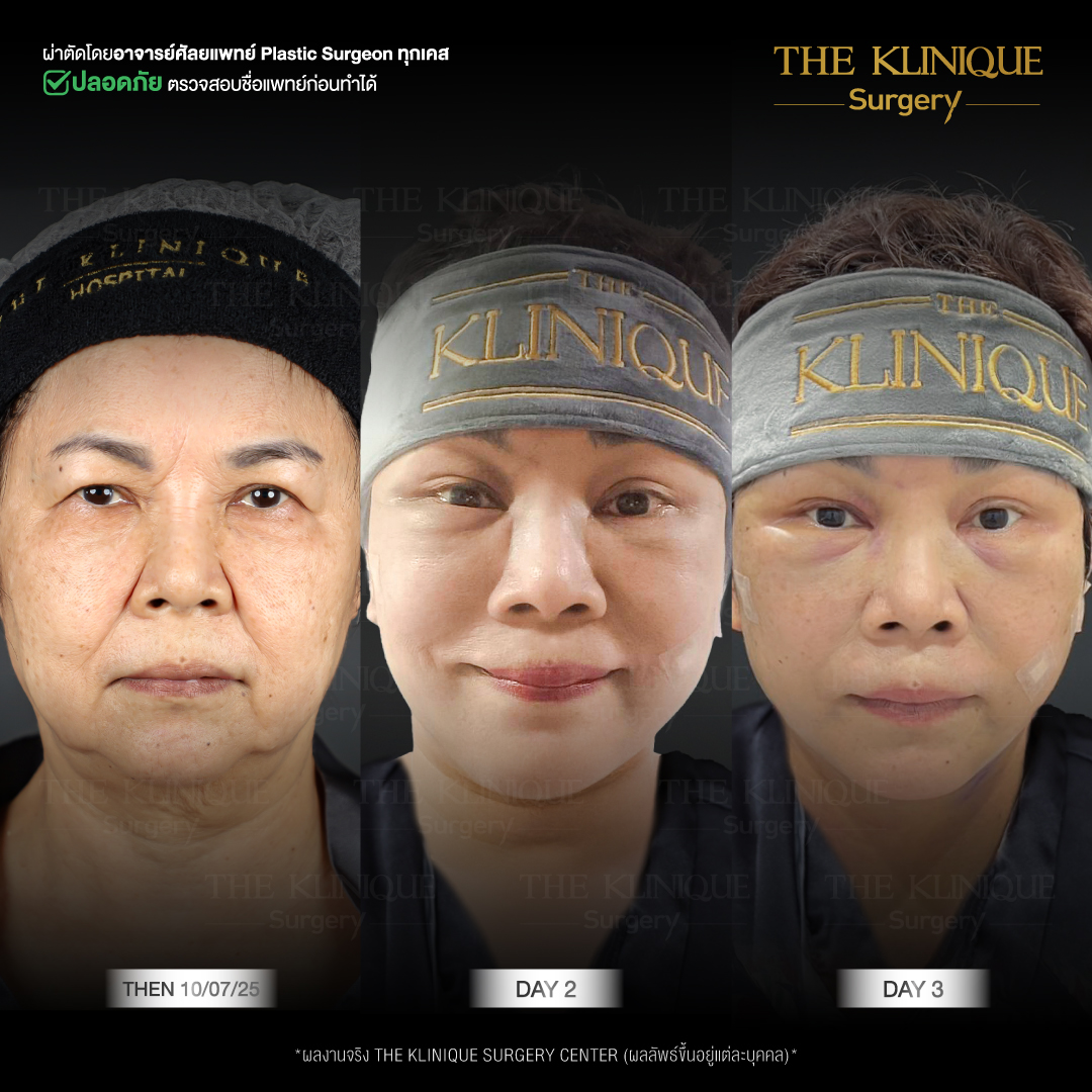 ศัลยกรรมดึงหน้า, ดึงหน้า, ดึงหน้าผาก, ดึงหน้าผาก ยกคิ้ว, Face Lock, Face Lift, ดึงหน้า ดึงคอ, ดึงหน้าย้อนวัย, ดึงหน้าดารา, Necklift, Face Lift คือ,Endotine หน้าผาก,ดึงหน้าผาก ยกคิ้ว, ศัลยกรรมดึงหน้าผาก, ดึงหน้าย้อนวัย, ศัลยกรรมยกคิ้ว, รีวิวศัลยกรรมยกคิ้ว, Endotine, Endotine รีวิว, ยกคิ้วส่องกล้อง, ผ่าตัดส่องกล้อง, ผ่าตัดดึงหน้า, Endotine รีวิว, ยกคิ้ว รีวิว, ยกคิ้วส่องกล้อง, ยกคิ้วส่องกล้อง รีวิว, ยกคิ้วที่ไหนดี