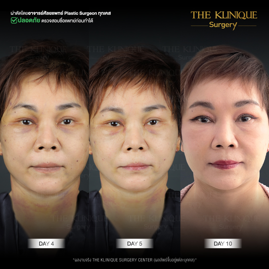 ศัลยกรรมดึงหน้า, ดึงหน้า, ดึงหน้าผาก, ดึงหน้าผาก ยกคิ้ว, Face Lock, Face Lift, ดึงหน้า ดึงคอ, ดึงหน้าย้อนวัย, ดึงหน้าดารา, Necklift, Face Lift คือ,Endotine หน้าผาก,ดึงหน้าผาก ยกคิ้ว, ศัลยกรรมดึงหน้าผาก, ดึงหน้าย้อนวัย, ศัลยกรรมยกคิ้ว, รีวิวศัลยกรรมยกคิ้ว, Endotine, Endotine รีวิว, ยกคิ้วส่องกล้อง, ผ่าตัดส่องกล้อง, ผ่าตัดดึงหน้า, Endotine รีวิว, ยกคิ้ว รีวิว, ยกคิ้วส่องกล้อง, ยกคิ้วส่องกล้อง รีวิว, ยกคิ้วที่ไหนดี