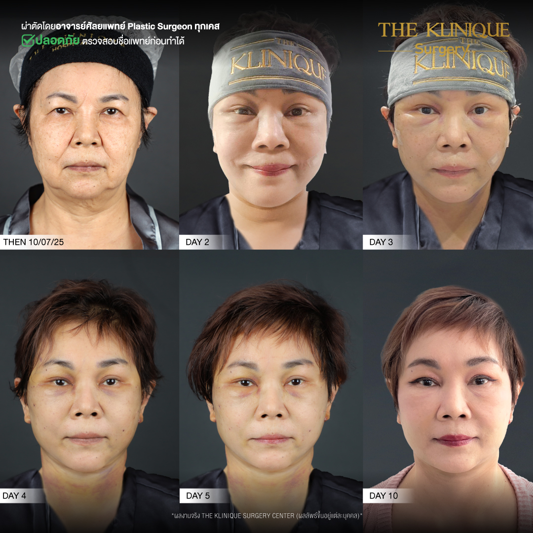 ศัลยกรรมดึงหน้า, ดึงหน้า, ดึงหน้าผาก, ดึงหน้าผาก ยกคิ้ว, Face Lock, Face Lift, ดึงหน้า ดึงคอ, ดึงหน้าย้อนวัย, ดึงหน้าดารา, Necklift, Face Lift คือ,Endotine หน้าผาก,ดึงหน้าผาก ยกคิ้ว, ศัลยกรรมดึงหน้าผาก, ดึงหน้าย้อนวัย, ศัลยกรรมยกคิ้ว, รีวิวศัลยกรรมยกคิ้ว, Endotine, Endotine รีวิว, ยกคิ้วส่องกล้อง, ผ่าตัดส่องกล้อง, ผ่าตัดดึงหน้า, Endotine รีวิว, ยกคิ้ว รีวิว, ยกคิ้วส่องกล้อง, ยกคิ้วส่องกล้อง รีวิว, ยกคิ้วที่ไหนดี