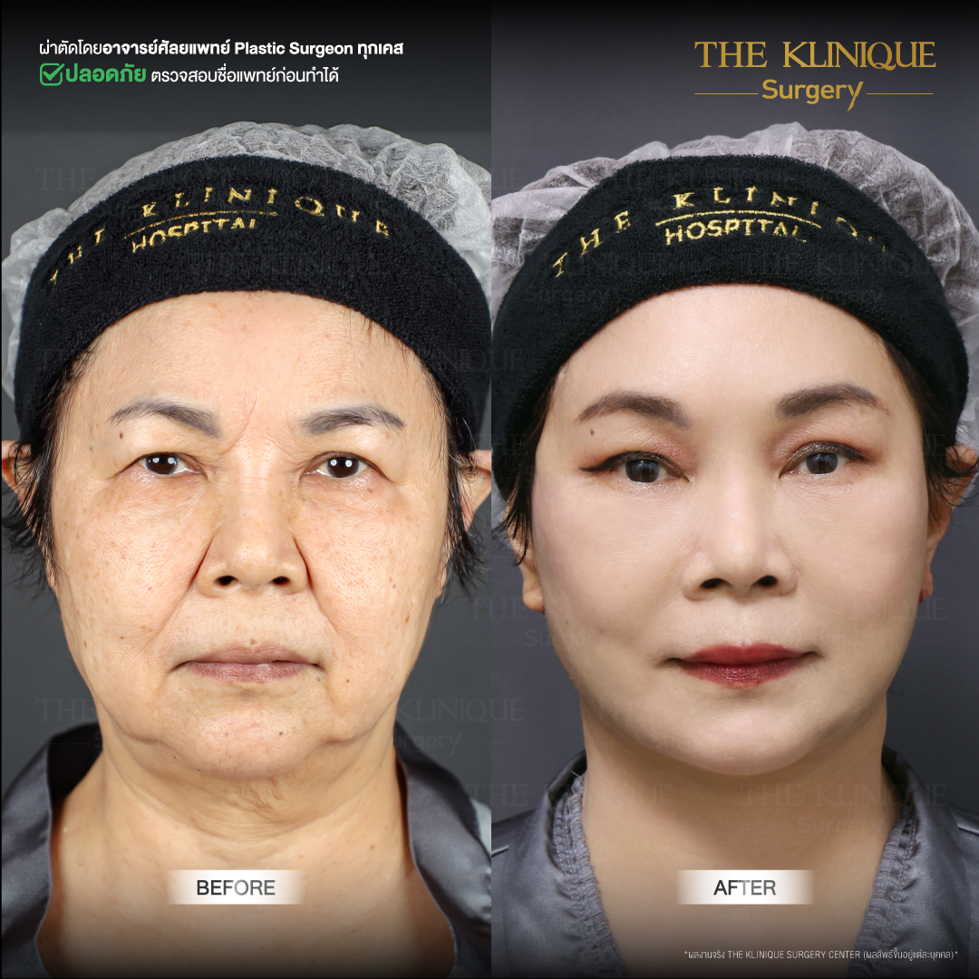 ศัลยกรรมดึงหน้า, ดึงหน้า, ดึงหน้าผาก, ดึงหน้าผาก ยกคิ้ว, Face Lock, Face Lift, ดึงหน้า ดึงคอ, ดึงหน้าย้อนวัย, ดึงหน้าดารา, Necklift, Face Lift คือ,Endotine หน้าผาก,ดึงหน้าผาก ยกคิ้ว, ศัลยกรรมดึงหน้าผาก, ดึงหน้าย้อนวัย, ศัลยกรรมยกคิ้ว, รีวิวศัลยกรรมยกคิ้ว, Endotine, Endotine รีวิว, ยกคิ้วส่องกล้อง, ผ่าตัดส่องกล้อง, ผ่าตัดดึงหน้า, Endotine รีวิว, ยกคิ้ว รีวิว, ยกคิ้วส่องกล้อง, ยกคิ้วส่องกล้อง รีวิว, ยกคิ้วที่ไหนดี