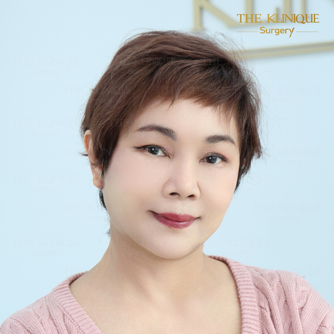 ศัลยกรรมดึงหน้า, ดึงหน้า, ดึงหน้าผาก, ดึงหน้าผาก ยกคิ้ว, Face Lock, Face Lift, ดึงหน้า ดึงคอ, ดึงหน้าย้อนวัย, ดึงหน้าดารา, Necklift, Face Lift คือ,Endotine หน้าผาก,ดึงหน้าผาก ยกคิ้ว, ศัลยกรรมดึงหน้าผาก, ดึงหน้าย้อนวัย, ศัลยกรรมยกคิ้ว, รีวิวศัลยกรรมยกคิ้ว, Endotine, Endotine รีวิว, ยกคิ้วส่องกล้อง, ผ่าตัดส่องกล้อง, ผ่าตัดดึงหน้า, Endotine รีวิว, ยกคิ้ว รีวิว, ยกคิ้วส่องกล้อง, ยกคิ้วส่องกล้อง รีวิว, ยกคิ้วที่ไหนดี