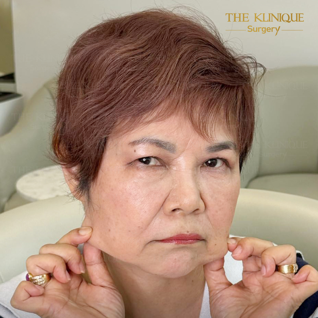 ศัลยกรรมดึงหน้า, ดึงหน้า, ดึงหน้าผาก, ดึงหน้าผาก ยกคิ้ว, Face Lock, Face Lift, ดึงหน้า ดึงคอ, ดึงหน้าย้อนวัย, ดึงหน้าดารา, Necklift, Face Lift คือ,Endotine หน้าผาก,ดึงหน้าผาก ยกคิ้ว, ศัลยกรรมดึงหน้าผาก, ดึงหน้าย้อนวัย, ศัลยกรรมยกคิ้ว, รีวิวศัลยกรรมยกคิ้ว, Endotine, Endotine รีวิว, ยกคิ้วส่องกล้อง, ผ่าตัดส่องกล้อง, ผ่าตัดดึงหน้า, Endotine รีวิว, ยกคิ้ว รีวิว, ยกคิ้วส่องกล้อง, ยกคิ้วส่องกล้อง รีวิว, ยกคิ้วที่ไหนดี