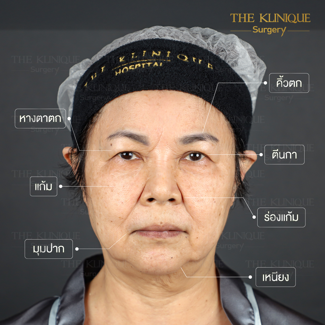 ศัลยกรรมดึงหน้า, ดึงหน้า, ดึงหน้าผาก, ดึงหน้าผาก ยกคิ้ว, Face Lock, Face Lift, ดึงหน้า ดึงคอ, ดึงหน้าย้อนวัย, ดึงหน้าดารา, Necklift, Face Lift คือ,Endotine หน้าผาก,ดึงหน้าผาก ยกคิ้ว, ศัลยกรรมดึงหน้าผาก, ดึงหน้าย้อนวัย, ศัลยกรรมยกคิ้ว, รีวิวศัลยกรรมยกคิ้ว, Endotine, Endotine รีวิว, ยกคิ้วส่องกล้อง, ผ่าตัดส่องกล้อง, ผ่าตัดดึงหน้า, Endotine รีวิว, ยกคิ้ว รีวิว, ยกคิ้วส่องกล้อง, ยกคิ้วส่องกล้อง รีวิว, ยกคิ้วที่ไหนดี