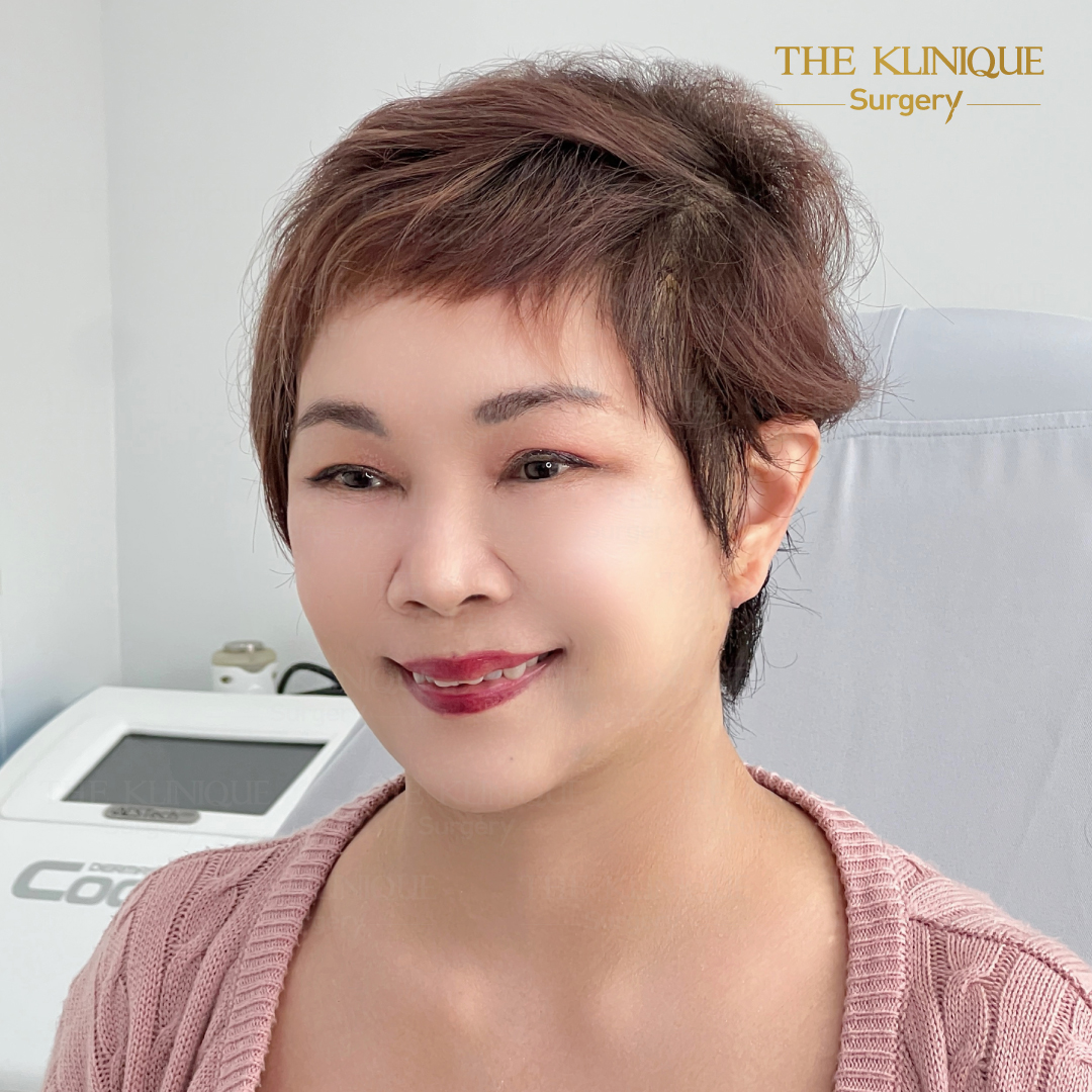 ศัลยกรรมดึงหน้า, ดึงหน้า, ดึงหน้าผาก, ดึงหน้าผาก ยกคิ้ว, Face Lock, Face Lift, ดึงหน้า ดึงคอ, ดึงหน้าย้อนวัย, ดึงหน้าดารา, Necklift, Face Lift คือ,Endotine หน้าผาก,ดึงหน้าผาก ยกคิ้ว, ศัลยกรรมดึงหน้าผาก, ดึงหน้าย้อนวัย, ศัลยกรรมยกคิ้ว, รีวิวศัลยกรรมยกคิ้ว, Endotine, Endotine รีวิว, ยกคิ้วส่องกล้อง, ผ่าตัดส่องกล้อง, ผ่าตัดดึงหน้า, Endotine รีวิว, ยกคิ้ว รีวิว, ยกคิ้วส่องกล้อง, ยกคิ้วส่องกล้อง รีวิว, ยกคิ้วที่ไหนดี