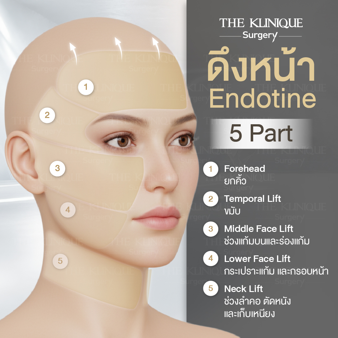 ศัลยกรรมดึงหน้า, ดึงหน้า, ดึงหน้าผาก, ดึงหน้าผาก ยกคิ้ว, Face Lock, Face Lift, ดึงหน้า ดึงคอ, ดึงหน้าย้อนวัย, ดึงหน้าดารา, Necklift, Face Lift คือ,Endotine หน้าผาก,ดึงหน้าผาก ยกคิ้ว, ศัลยกรรมดึงหน้าผาก, ดึงหน้าย้อนวัย, ศัลยกรรมยกคิ้ว, รีวิวศัลยกรรมยกคิ้ว, Endotine, Endotine รีวิว, ยกคิ้วส่องกล้อง, ผ่าตัดส่องกล้อง, ผ่าตัดดึงหน้า, Endotine รีวิว, ยกคิ้ว รีวิว, ยกคิ้วส่องกล้อง, ยกคิ้วส่องกล้อง รีวิว, ยกคิ้วที่ไหนดี