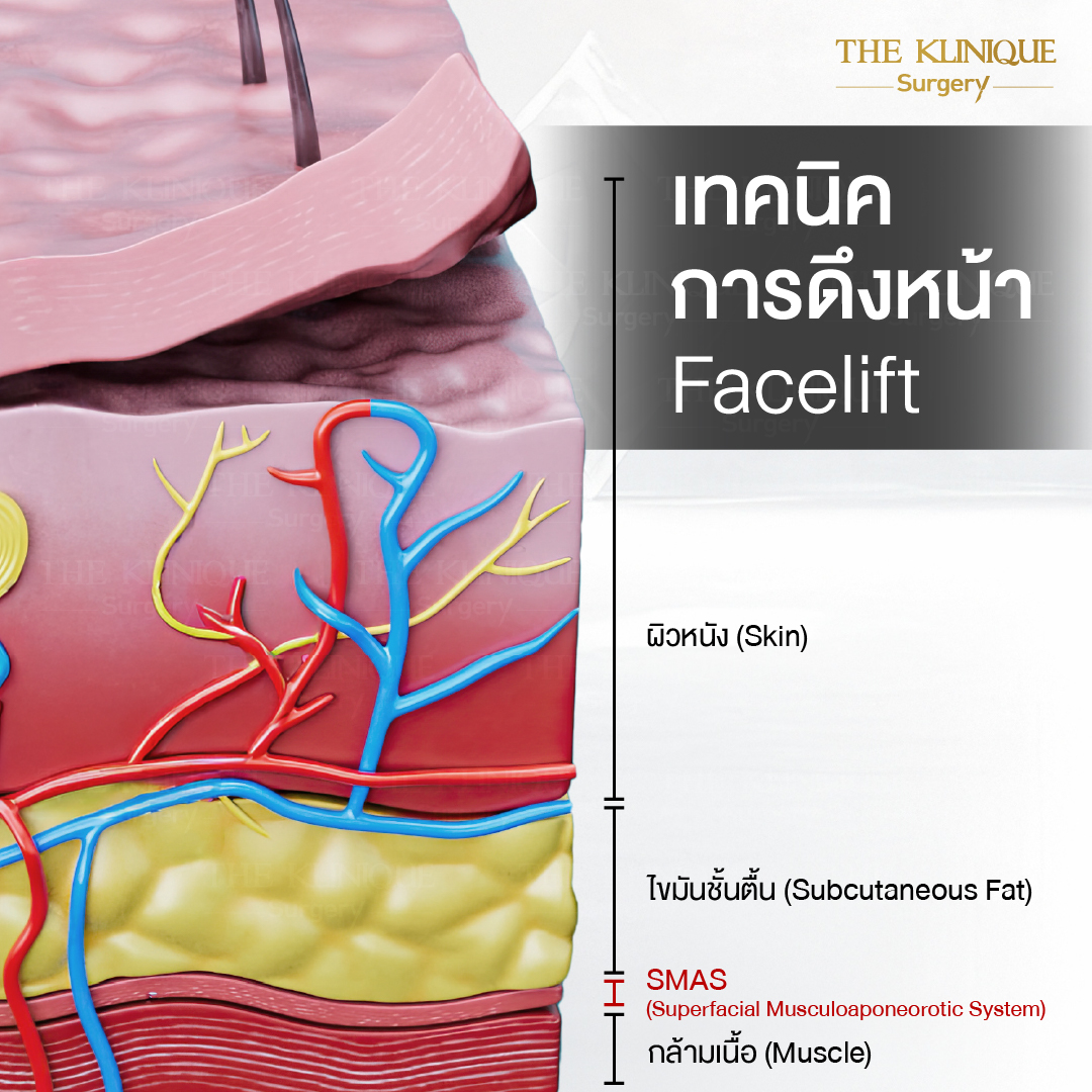 ศัลยกรรมดึงหน้า, ดึงหน้า, ดึงหน้าผาก, ดึงหน้าผาก ยกคิ้ว, Face Lock, Face Lift, ดึงหน้า ดึงคอ, ดึงหน้าย้อนวัย, ดึงหน้าดารา, Necklift, Face Lift คือ,Endotine หน้าผาก,ดึงหน้าผาก ยกคิ้ว, ศัลยกรรมดึงหน้าผาก, ดึงหน้าย้อนวัย, ศัลยกรรมยกคิ้ว, รีวิวศัลยกรรมยกคิ้ว, Endotine, Endotine รีวิว, ยกคิ้วส่องกล้อง, ผ่าตัดส่องกล้อง, ผ่าตัดดึงหน้า, Endotine รีวิว, ยกคิ้ว รีวิว, ยกคิ้วส่องกล้อง, ยกคิ้วส่องกล้อง รีวิว, ยกคิ้วที่ไหนดี
