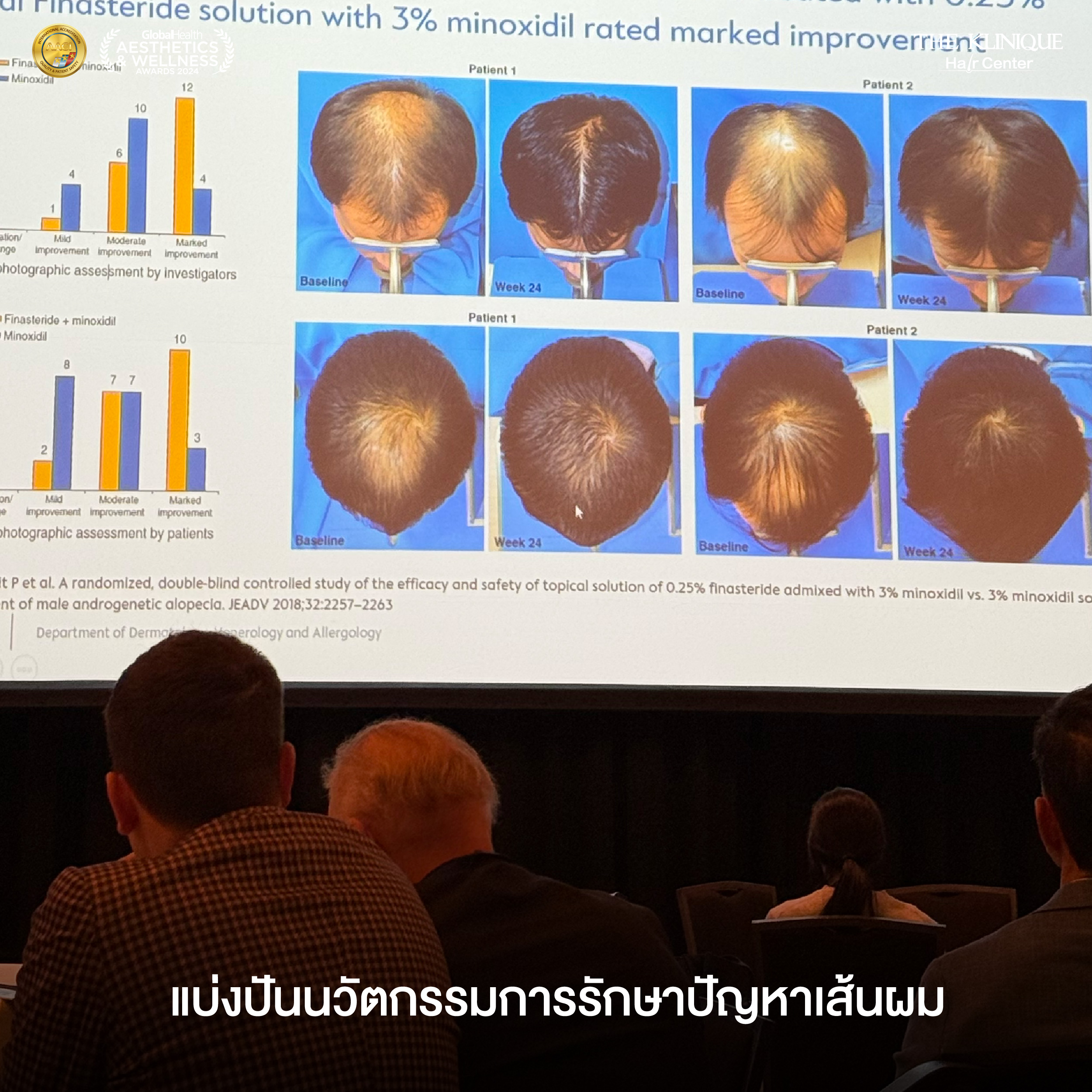 ศัลยกรรมปลูกผม, ปลูกผมที่ไหนดี, ปลูกผมราคา, ปลูกผมถาวร, ปลูกผม ผมบาง, ปลูกผม ถาวร ราคา,ผมร่วง, ผมร่วงเกิดจากอะไร, ผมร่วง ปลูกผม, ปัญหาผมร่วง, ลดผมร่วง, แก้ผมร่วง, แก้ผมขาดร่วง, คลินกปลูกผม,ปลูกผมบาง, รากผมฝ่อ,ผมบาง, ปลูกผม, วิธีแก้ผมบาง, ศูนย์ดูแลเส้นผม, hair center, หัวเถิก, หัวล้าน, ศีรษะล้าน, ปลูกผมเทคนิคไหนดี, ปลูกผมมีกี่แบบ, ปลูกผม FUE, ปลูกผม DHI, รีวิว ปลูกผม , เซลล์กราผม, ยาปลูกผม, กราฟผม, กราฟปลูกผม, กระตุ้นรากผม, กระตุ้นเซลล์ผม, รากผมอ่อนแอ, ปัญหาผม,รักษาเส้นผม, รักษาผมร่วง, รักษารากผม, รักษาผมบาง