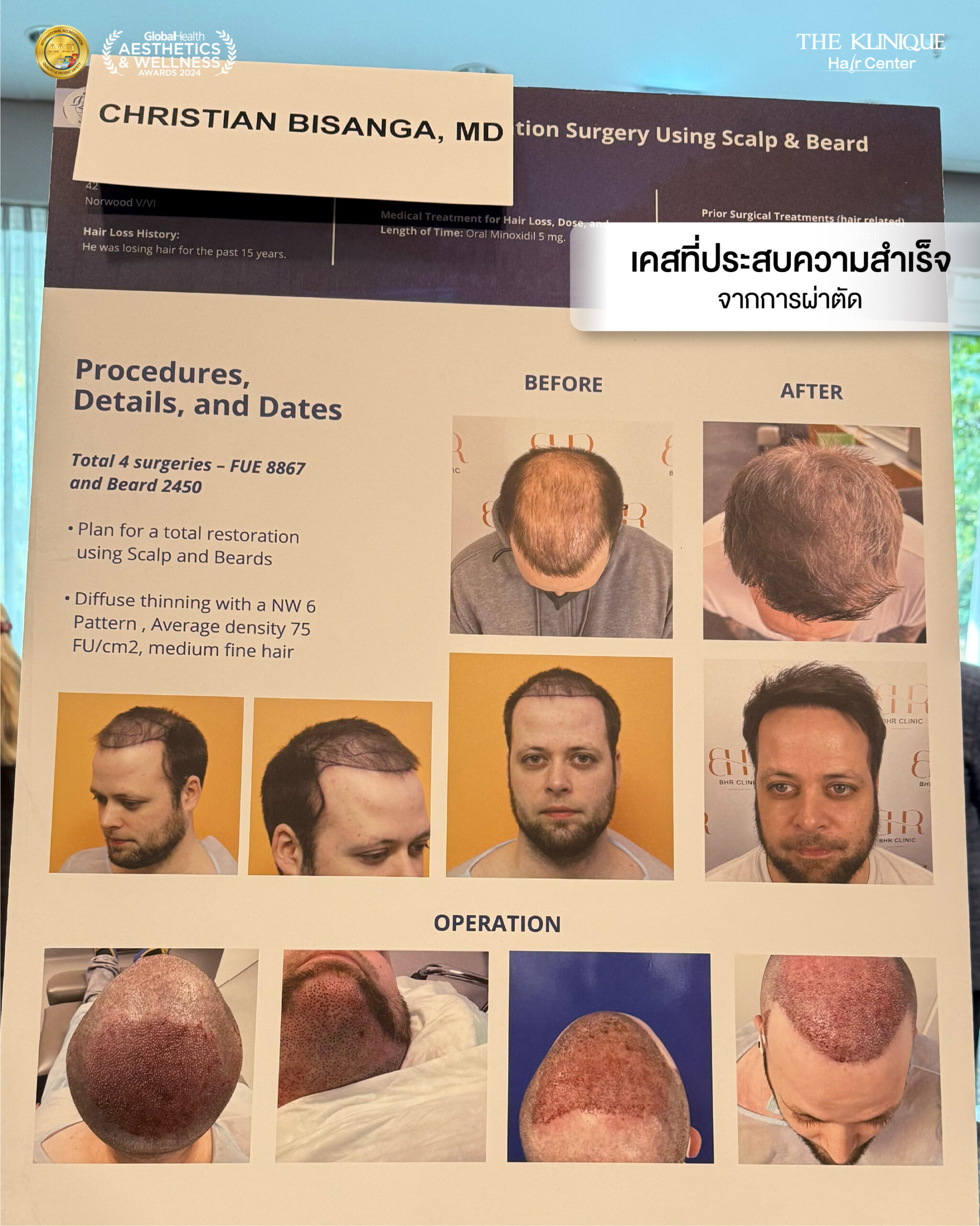 ศัลยกรรมปลูกผม, ปลูกผมที่ไหนดี, ปลูกผมราคา, ปลูกผมถาวร, ปลูกผม ผมบาง, ปลูกผม ถาวร ราคา,ผมร่วง, ผมร่วงเกิดจากอะไร, ผมร่วง ปลูกผม, ปัญหาผมร่วง, ลดผมร่วง, แก้ผมร่วง, แก้ผมขาดร่วง, คลินกปลูกผม,ปลูกผมบาง, รากผมฝ่อ,ผมบาง, ปลูกผม, วิธีแก้ผมบาง, ศูนย์ดูแลเส้นผม, hair center, หัวเถิก, หัวล้าน, ศีรษะล้าน, ปลูกผมเทคนิคไหนดี, ปลูกผมมีกี่แบบ, ปลูกผม FUE, ปลูกผม DHI, รีวิว ปลูกผม , เซลล์กราผม, ยาปลูกผม, กราฟผม, กราฟปลูกผม, กระตุ้นรากผม, กระตุ้นเซลล์ผม, รากผมอ่อนแอ, ปัญหาผม,รักษาเส้นผม, รักษาผมร่วง, รักษารากผม, รักษาผมบาง