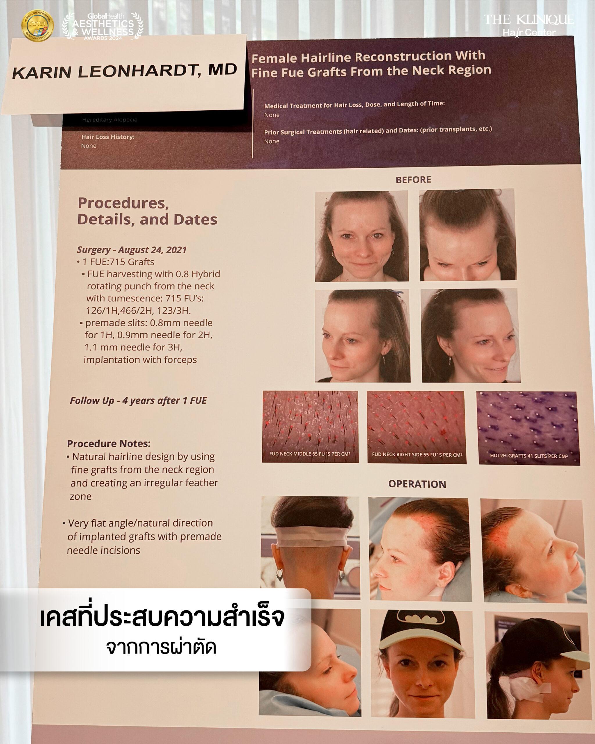 ศัลยกรรมปลูกผม, ปลูกผมที่ไหนดี, ปลูกผมราคา, ปลูกผมถาวร, ปลูกผม ผมบาง, ปลูกผม ถาวร ราคา,ผมร่วง, ผมร่วงเกิดจากอะไร, ผมร่วง ปลูกผม, ปัญหาผมร่วง, ลดผมร่วง, แก้ผมร่วง, แก้ผมขาดร่วง, คลินกปลูกผม,ปลูกผมบาง, รากผมฝ่อ,ผมบาง, ปลูกผม, วิธีแก้ผมบาง, ศูนย์ดูแลเส้นผม, hair center, หัวเถิก, หัวล้าน, ศีรษะล้าน, ปลูกผมเทคนิคไหนดี, ปลูกผมมีกี่แบบ, ปลูกผม FUE, ปลูกผม DHI, รีวิว ปลูกผม , เซลล์กราผม, ยาปลูกผม, กราฟผม, กราฟปลูกผม, กระตุ้นรากผม, กระตุ้นเซลล์ผม, รากผมอ่อนแอ, ปัญหาผม,รักษาเส้นผม, รักษาผมร่วง, รักษารากผม, รักษาผมบาง