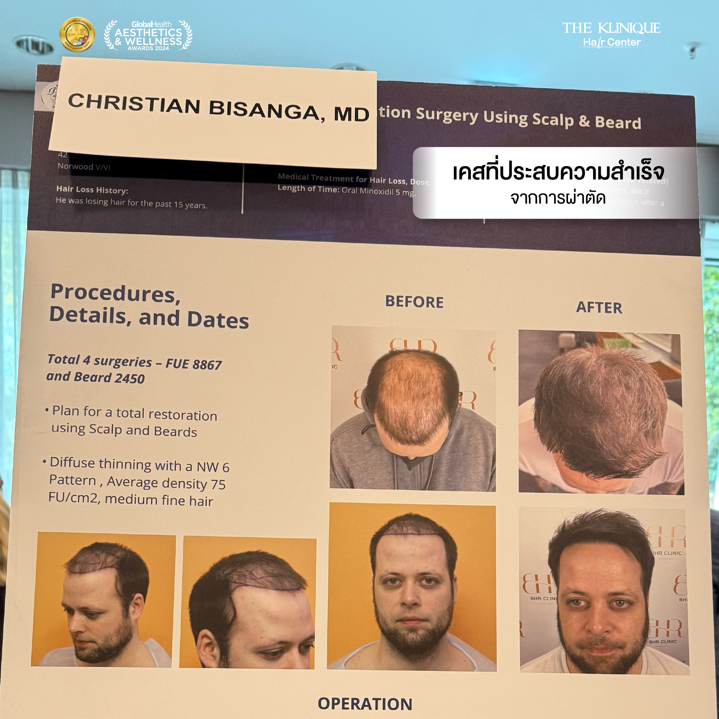 ศัลยกรรมปลูกผม, ปลูกผมที่ไหนดี, ปลูกผมราคา, ปลูกผมถาวร, ปลูกผม ผมบาง, ปลูกผม ถาวร ราคา,ผมร่วง, ผมร่วงเกิดจากอะไร, ผมร่วง ปลูกผม, ปัญหาผมร่วง, ลดผมร่วง, แก้ผมร่วง, แก้ผมขาดร่วง, คลินกปลูกผม,ปลูกผมบาง, รากผมฝ่อ,ผมบาง, ปลูกผม, วิธีแก้ผมบาง, ศูนย์ดูแลเส้นผม, hair center, หัวเถิก, หัวล้าน, ศีรษะล้าน, ปลูกผมเทคนิคไหนดี, ปลูกผมมีกี่แบบ, ปลูกผม FUE, ปลูกผม DHI, รีวิว ปลูกผม , เซลล์กราผม, ยาปลูกผม, กราฟผม, กราฟปลูกผม, กระตุ้นรากผม, กระตุ้นเซลล์ผม, รากผมอ่อนแอ, ปัญหาผม,รักษาเส้นผม, รักษาผมร่วง, รักษารากผม, รักษาผมบาง