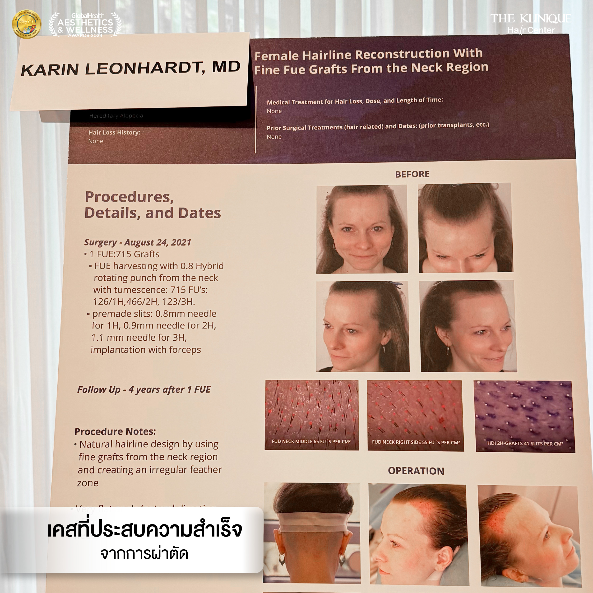 ศัลยกรรมปลูกผม, ปลูกผมที่ไหนดี, ปลูกผมราคา, ปลูกผมถาวร, ปลูกผม ผมบาง, ปลูกผม ถาวร ราคา,ผมร่วง, ผมร่วงเกิดจากอะไร, ผมร่วง ปลูกผม, ปัญหาผมร่วง, ลดผมร่วง, แก้ผมร่วง, แก้ผมขาดร่วง, คลินกปลูกผม,ปลูกผมบาง, รากผมฝ่อ,ผมบาง, ปลูกผม, วิธีแก้ผมบาง, ศูนย์ดูแลเส้นผม, hair center, หัวเถิก, หัวล้าน, ศีรษะล้าน, ปลูกผมเทคนิคไหนดี, ปลูกผมมีกี่แบบ, ปลูกผม FUE, ปลูกผม DHI, รีวิว ปลูกผม , เซลล์กราผม, ยาปลูกผม, กราฟผม, กราฟปลูกผม, กระตุ้นรากผม, กระตุ้นเซลล์ผม, รากผมอ่อนแอ, ปัญหาผม,รักษาเส้นผม, รักษาผมร่วง, รักษารากผม, รักษาผมบาง