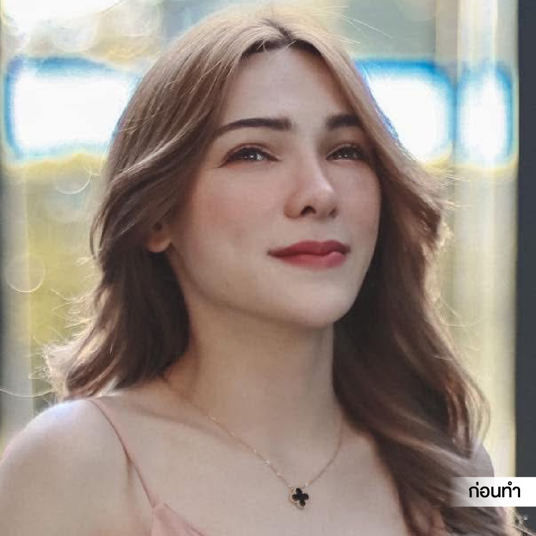 ศัลยกรรมดึงหน้า, ดึงหน้า, ดึงหน้าผาก, ดึงหน้าผาก ยกคิ้ว, Face Lock, Face Lift, ดึงหน้า ดึงคอ, ดึงหน้าย้อนวัย, ดึงหน้าดารา, Necklift, Face Lift คือ,Endotine หน้าผาก,ดึงหน้าผาก ยกคิ้ว, ศัลยกรรมดึงหน้าผาก, ดึงหน้าย้อนวัย, ศัลยกรรมยกคิ้ว, รีวิวศัลยกรรมยกคิ้ว, Endotine, Endotine รีวิว, ยกคิ้วส่องกล้อง, ผ่าตัดส่องกล้อง, ผ่าตัดดึงหน้า, Endotine รีวิว, ยกคิ้ว รีวิว, ยกคิ้วส่องกล้อง, ยกคิ้วส่องกล้อง รีวิว, ยกคิ้วที่ไหนดี