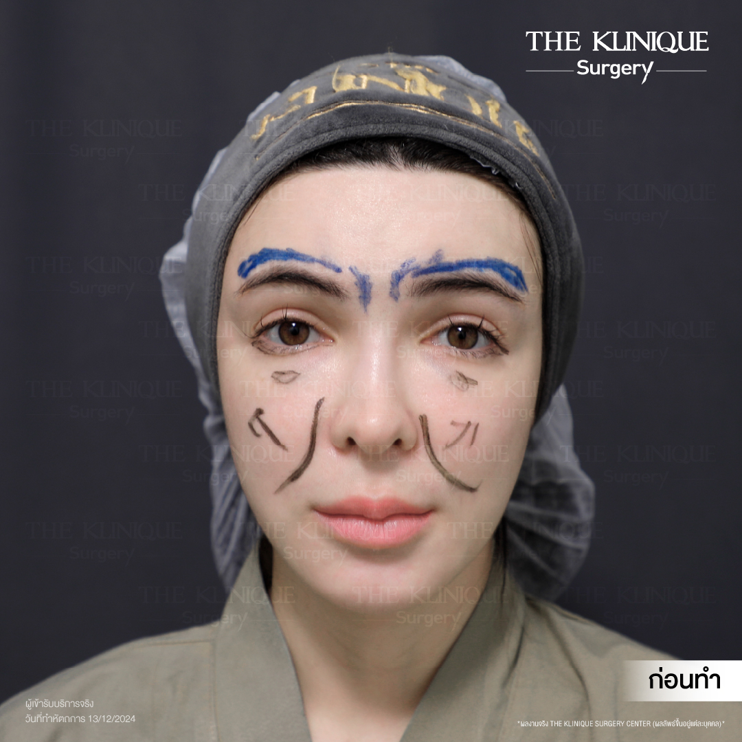ศัลยกรรมดึงหน้า, ดึงหน้า, ดึงหน้าผาก, ดึงหน้าผาก ยกคิ้ว, Face Lock, Face Lift, ดึงหน้า ดึงคอ, ดึงหน้าย้อนวัย, ดึงหน้าดารา, Necklift, Face Lift คือ,Endotine หน้าผาก,ดึงหน้าผาก ยกคิ้ว, ศัลยกรรมดึงหน้าผาก, ดึงหน้าย้อนวัย, ศัลยกรรมยกคิ้ว, รีวิวศัลยกรรมยกคิ้ว, Endotine, Endotine รีวิว, ยกคิ้วส่องกล้อง, ผ่าตัดส่องกล้อง, ผ่าตัดดึงหน้า, Endotine รีวิว, ยกคิ้ว รีวิว, ยกคิ้วส่องกล้อง, ยกคิ้วส่องกล้อง รีวิว, ยกคิ้วที่ไหนดี
