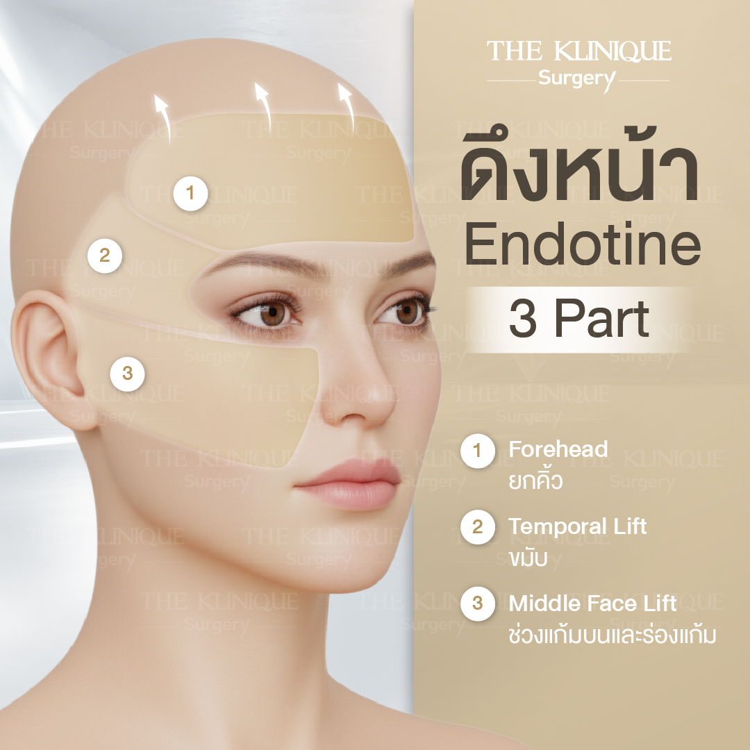 ศัลยกรรมดึงหน้า, ดึงหน้า, ดึงหน้าผาก, ดึงหน้าผาก ยกคิ้ว, Face Lock, Face Lift, ดึงหน้า ดึงคอ, ดึงหน้าย้อนวัย, ดึงหน้าดารา, Necklift, Face Lift คือ,Endotine หน้าผาก,ดึงหน้าผาก ยกคิ้ว, ศัลยกรรมดึงหน้าผาก, ดึงหน้าย้อนวัย, ศัลยกรรมยกคิ้ว, รีวิวศัลยกรรมยกคิ้ว, Endotine, Endotine รีวิว, ยกคิ้วส่องกล้อง, ผ่าตัดส่องกล้อง, ผ่าตัดดึงหน้า, Endotine รีวิว, ยกคิ้ว รีวิว, ยกคิ้วส่องกล้อง, ยกคิ้วส่องกล้อง รีวิว, ยกคิ้วที่ไหนดี