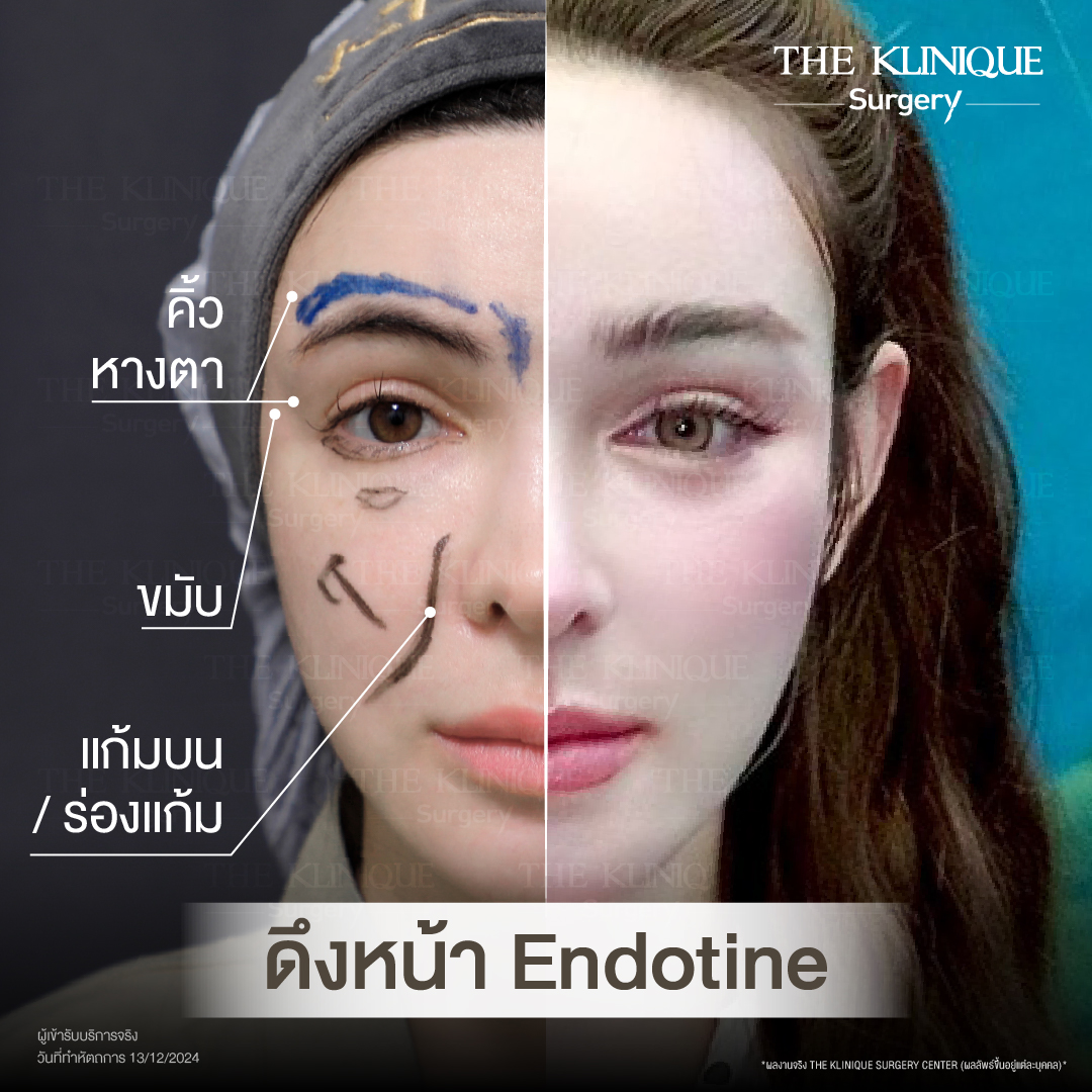 ศัลยกรรมดึงหน้า, ดึงหน้า, ดึงหน้าผาก, ดึงหน้าผาก ยกคิ้ว, Face Lock, Face Lift, ดึงหน้า ดึงคอ, ดึงหน้าย้อนวัย, ดึงหน้าดารา, Necklift, Face Lift คือ,Endotine หน้าผาก,ดึงหน้าผาก ยกคิ้ว, ศัลยกรรมดึงหน้าผาก, ดึงหน้าย้อนวัย, ศัลยกรรมยกคิ้ว, รีวิวศัลยกรรมยกคิ้ว, Endotine, Endotine รีวิว, ยกคิ้วส่องกล้อง, ผ่าตัดส่องกล้อง, ผ่าตัดดึงหน้า, Endotine รีวิว, ยกคิ้ว รีวิว, ยกคิ้วส่องกล้อง, ยกคิ้วส่องกล้อง รีวิว, ยกคิ้วที่ไหนดี