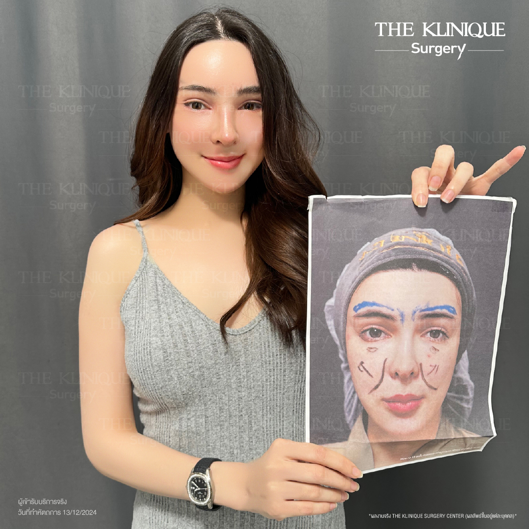 ศัลยกรรมดึงหน้า, ดึงหน้า, ดึงหน้าผาก, ดึงหน้าผาก ยกคิ้ว, Face Lock, Face Lift, ดึงหน้า ดึงคอ, ดึงหน้าย้อนวัย, ดึงหน้าดารา, Necklift, Face Lift คือ,Endotine หน้าผาก,ดึงหน้าผาก ยกคิ้ว, ศัลยกรรมดึงหน้าผาก, ดึงหน้าย้อนวัย, ศัลยกรรมยกคิ้ว, รีวิวศัลยกรรมยกคิ้ว, Endotine, Endotine รีวิว, ยกคิ้วส่องกล้อง, ผ่าตัดส่องกล้อง, ผ่าตัดดึงหน้า, Endotine รีวิว, ยกคิ้ว รีวิว, ยกคิ้วส่องกล้อง, ยกคิ้วส่องกล้อง รีวิว, ยกคิ้วที่ไหนดี